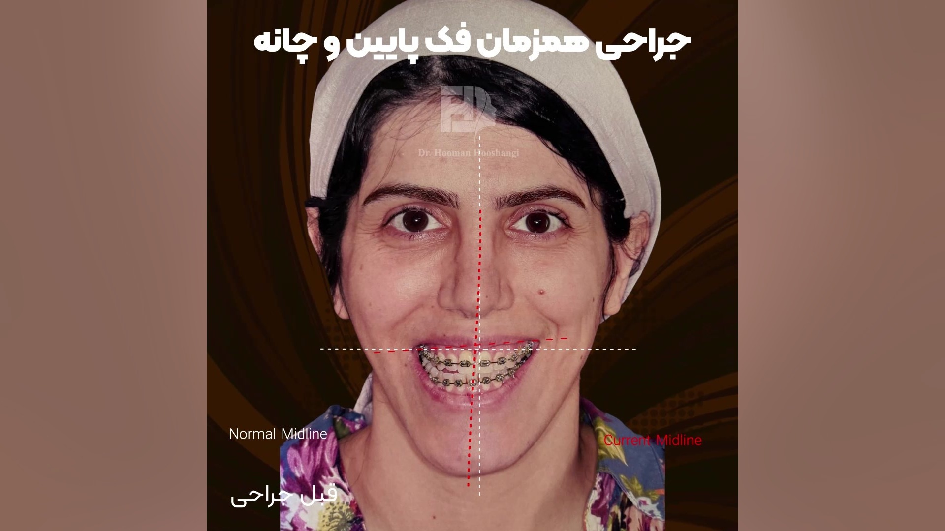 قبل و بعد از جراحی فک هپاتواسپلنومگالی