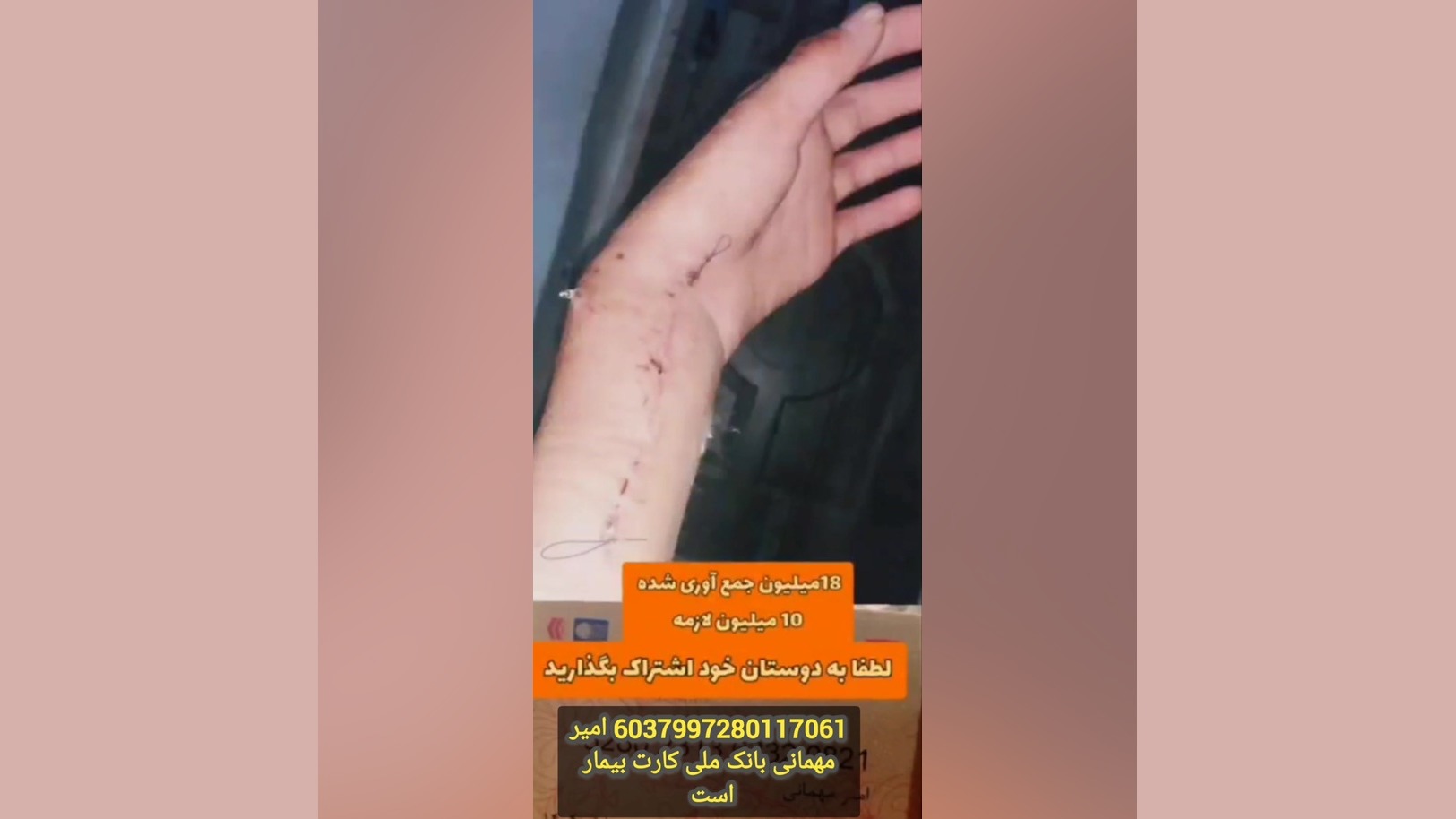 نیازمند کمک فوری برای عمل جراحی میکرونیدلینگ
