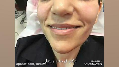 پر کردن و جوانسازی خط خنده دکتر فرحناز زینعلی - متخصص پوست، مو، زیبایی زنجان