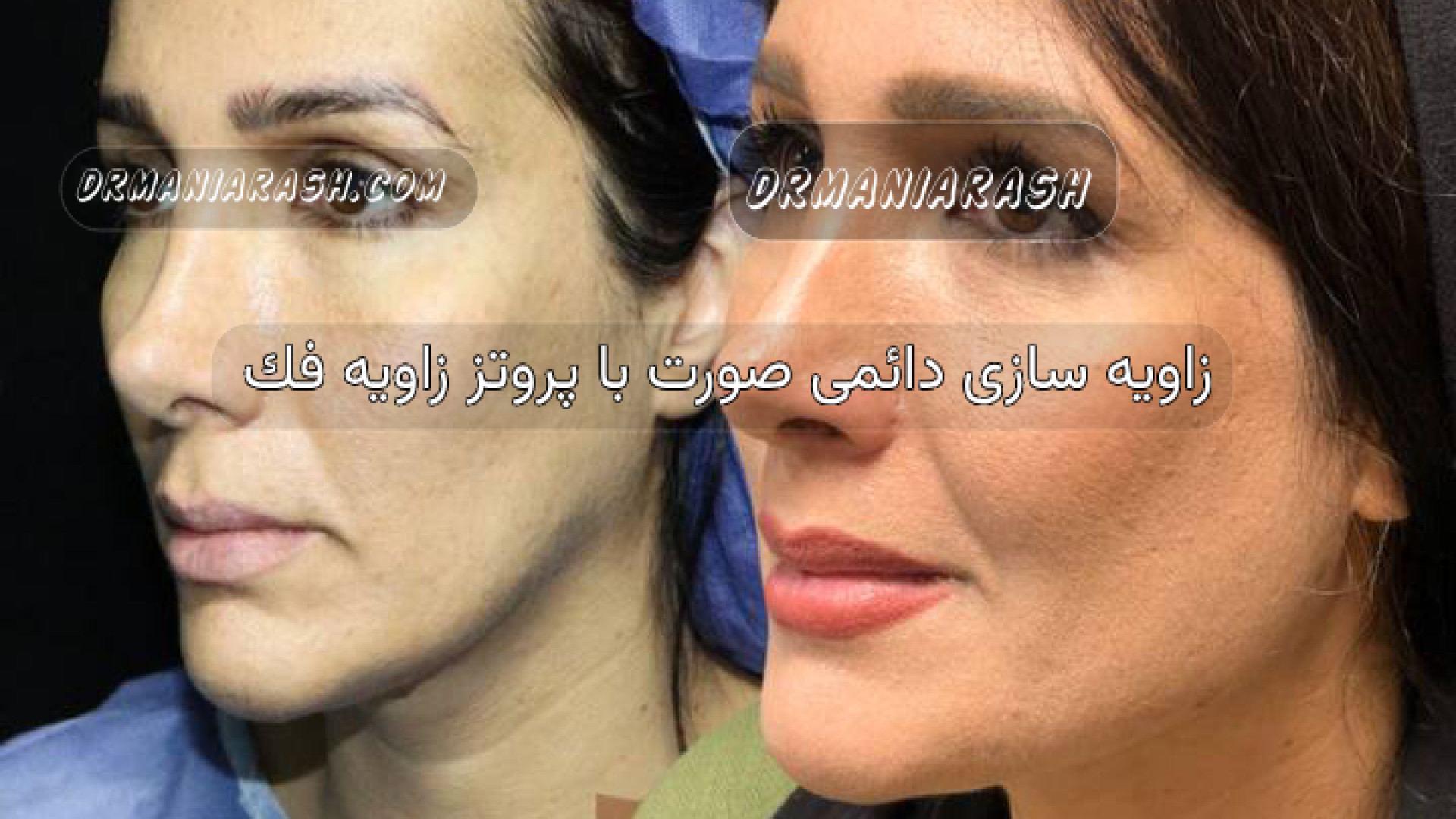 زاویه سازی دائمی صورت با پروتز زاويه فك تزریق بوتاکس