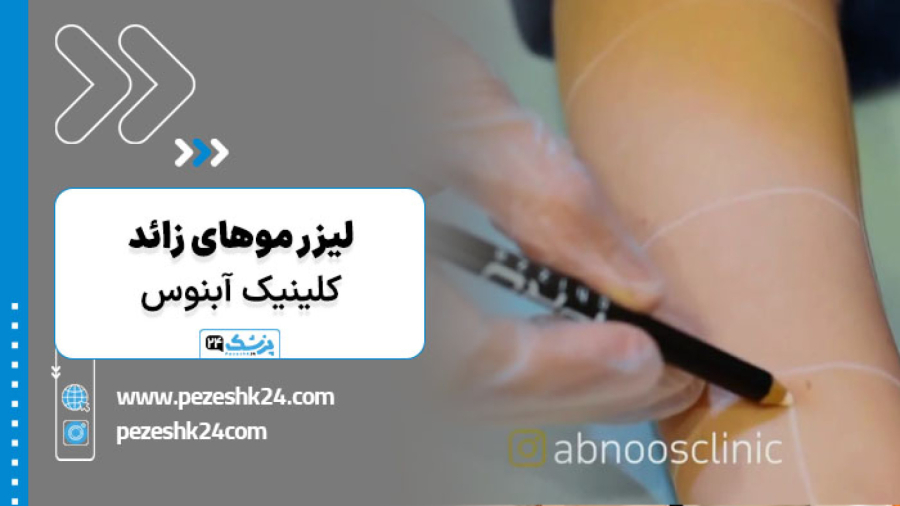 فیلم لیزر موهای زائد در کلینیک آبنوس مشهد| پزشک 24