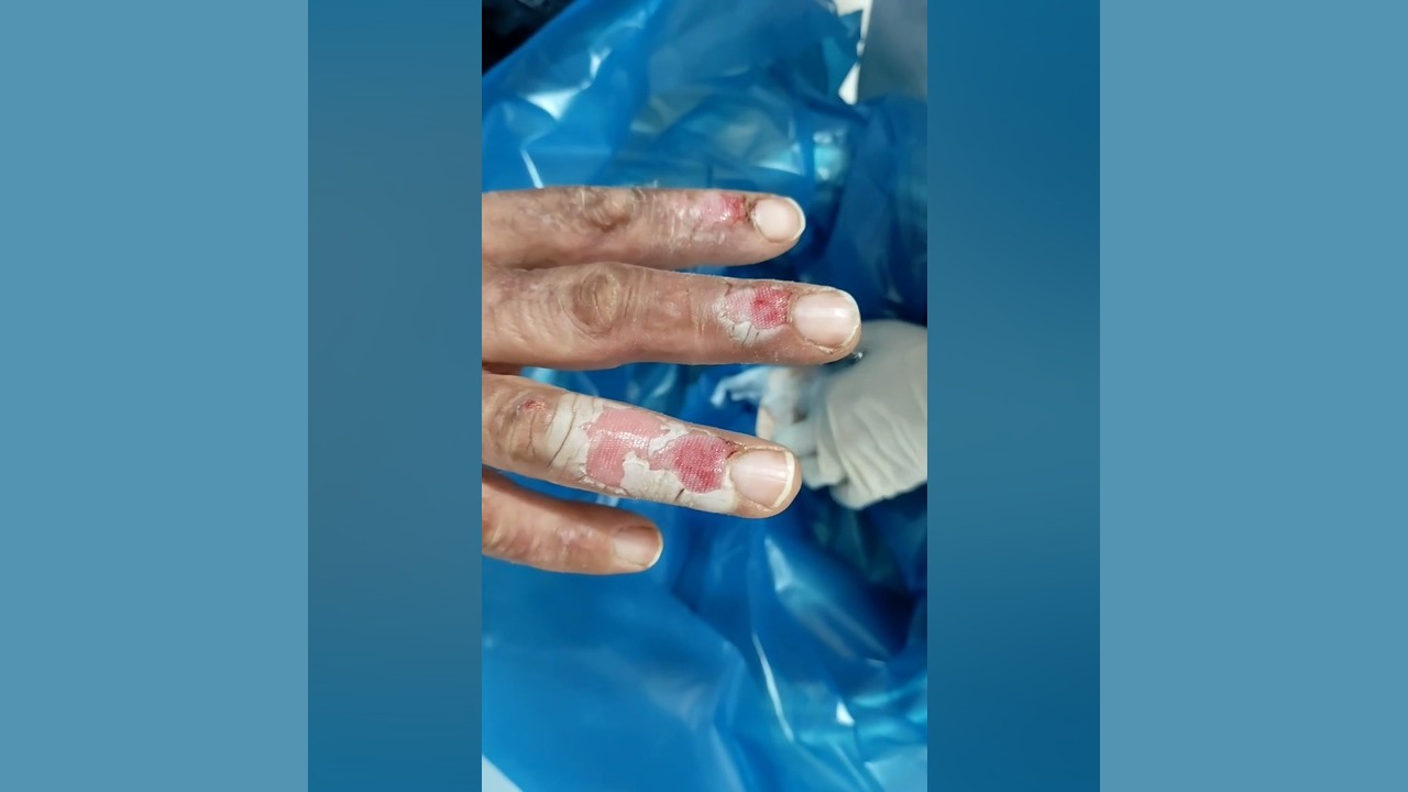 جلسه سوم درمان زخم سوختگی با استفاده از پانسمان پلاس مویست زویکو کلینیک زیبایی