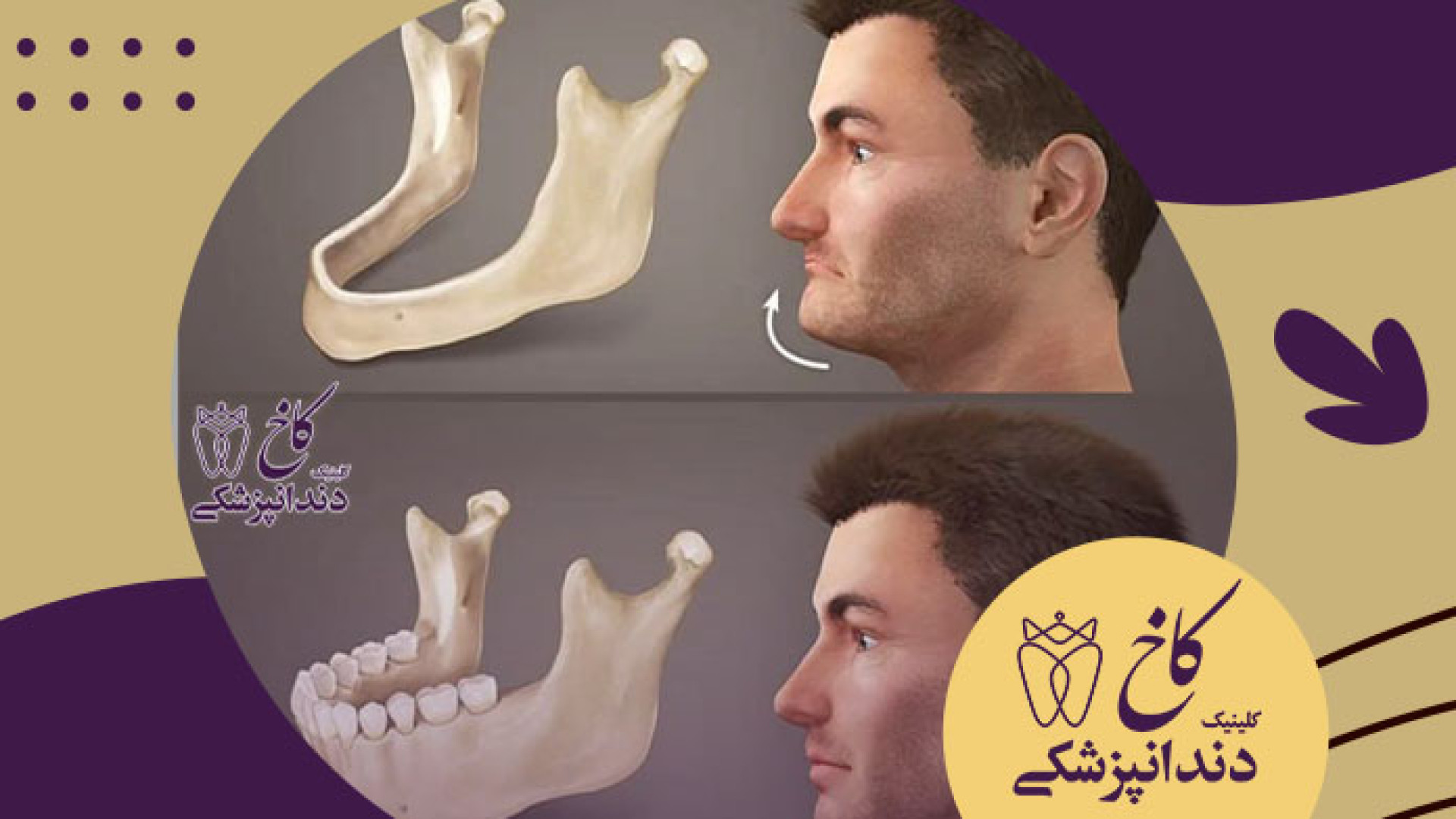 وقتی ایمپلنت نگذاریم چه میشود کلینیک دندانپزشکی کاخ