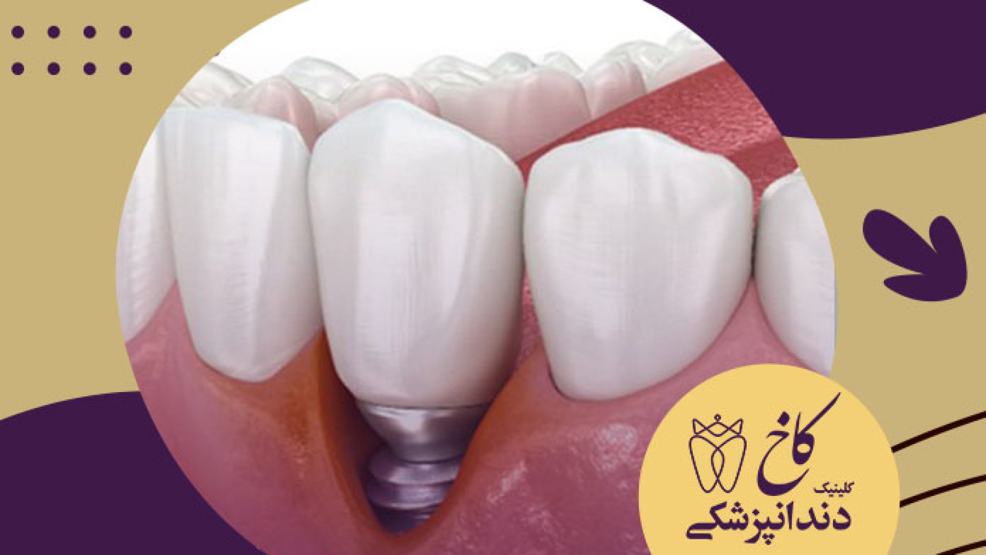 دلیل نگرفتن ایمپلنت کلینیک دندانپزشکی کاخ