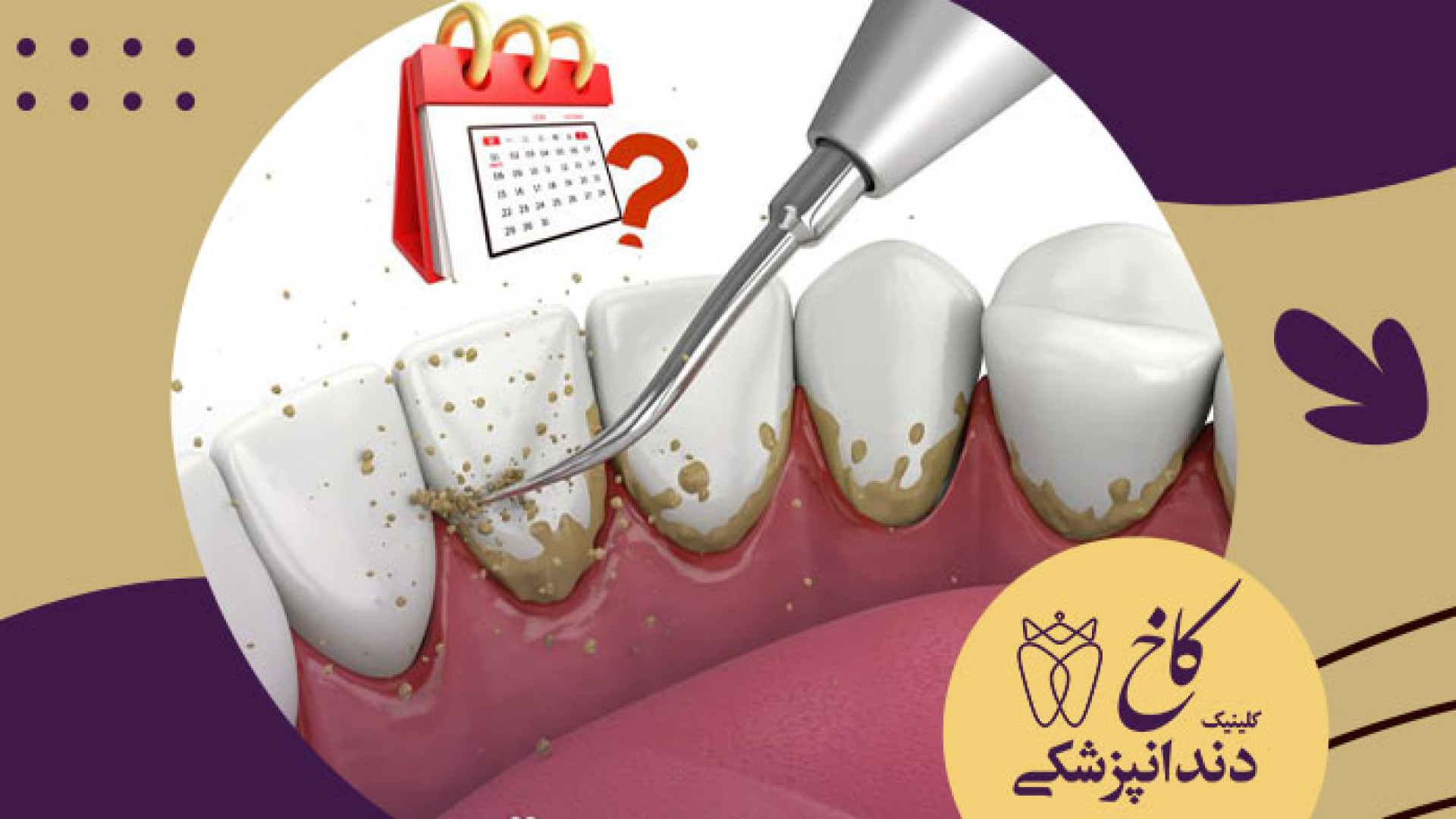 هرچند وقت یکبار جرم گیری باید انجام بشه کلینیک دندانپزشکی کاخ