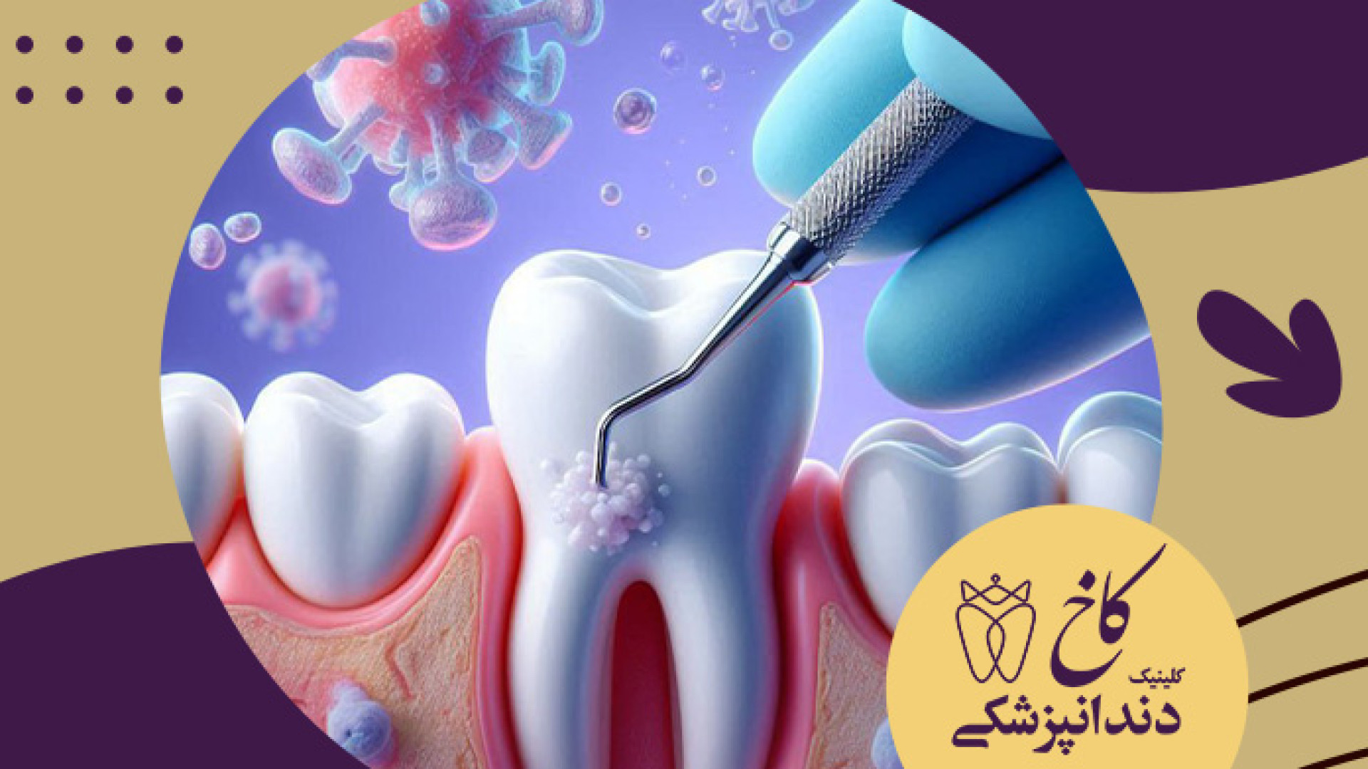 اول بلیچینگ یا جرم گیری؟ کلینیک دندانپزشکی کاخ