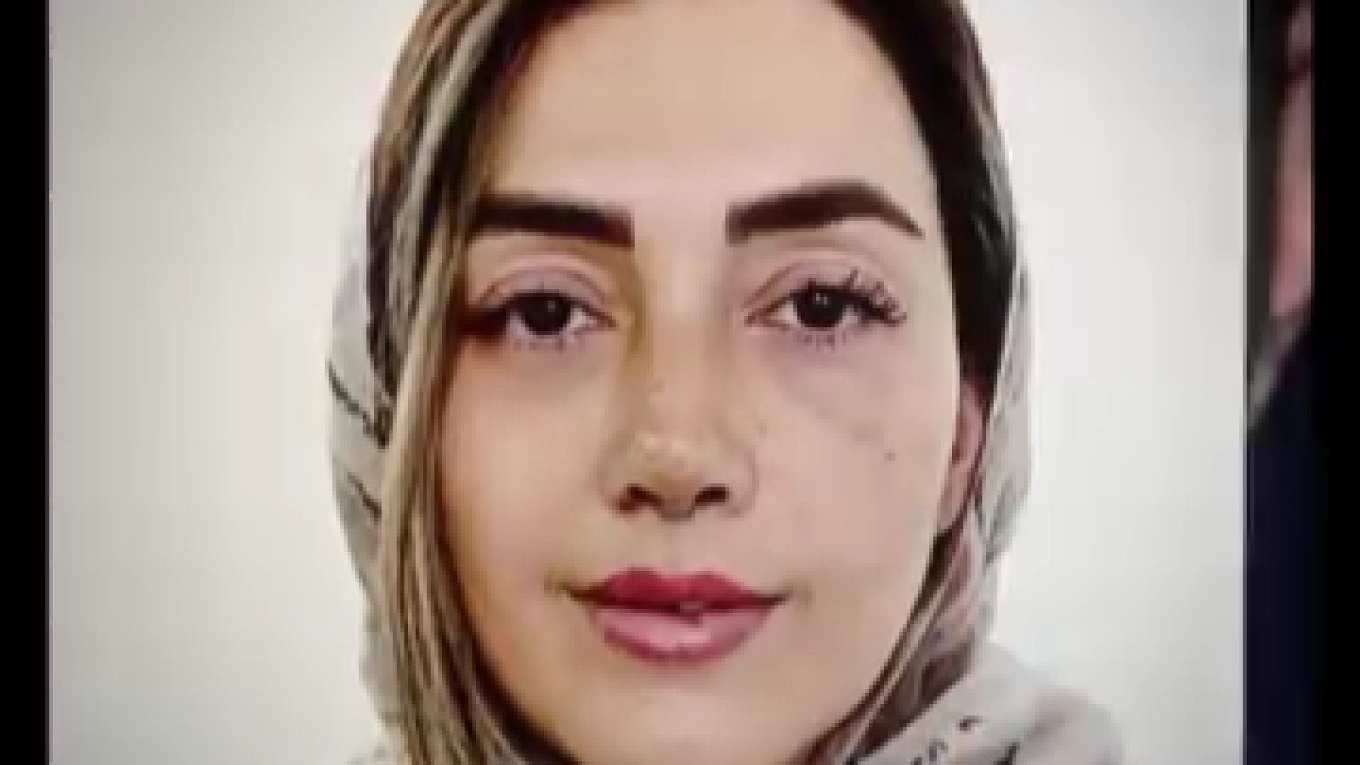 نتیجه عمل بینی فقط دو هفته بعد از عمل جراحی لثه