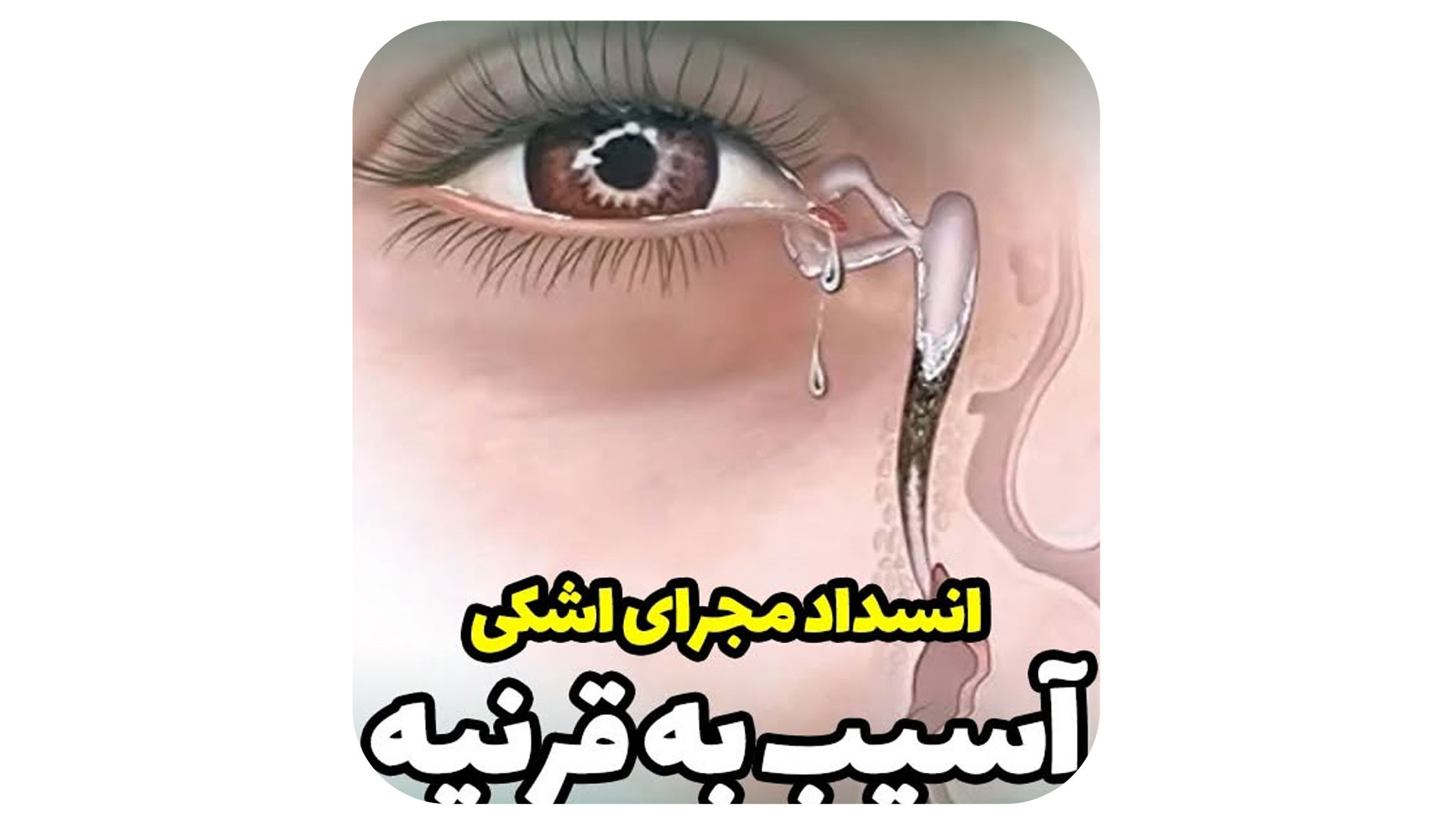 هزینه عمل مجرای اشکی در سال 1404 دکتر حامد محمدی قهاری