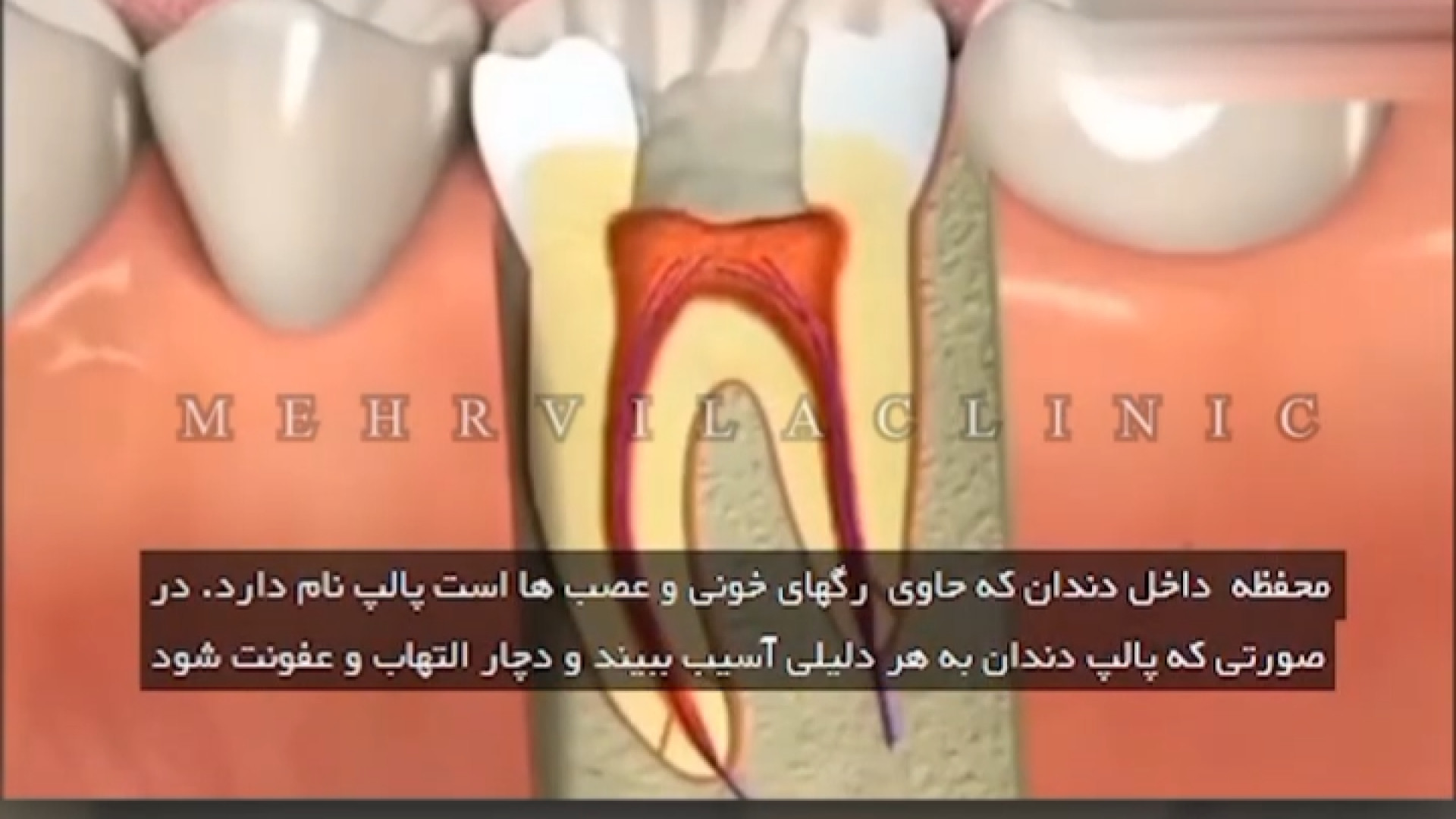 عصب کشی دندان در کلینیک دندانپزشکی مهرویلا کرج گلابی زرین