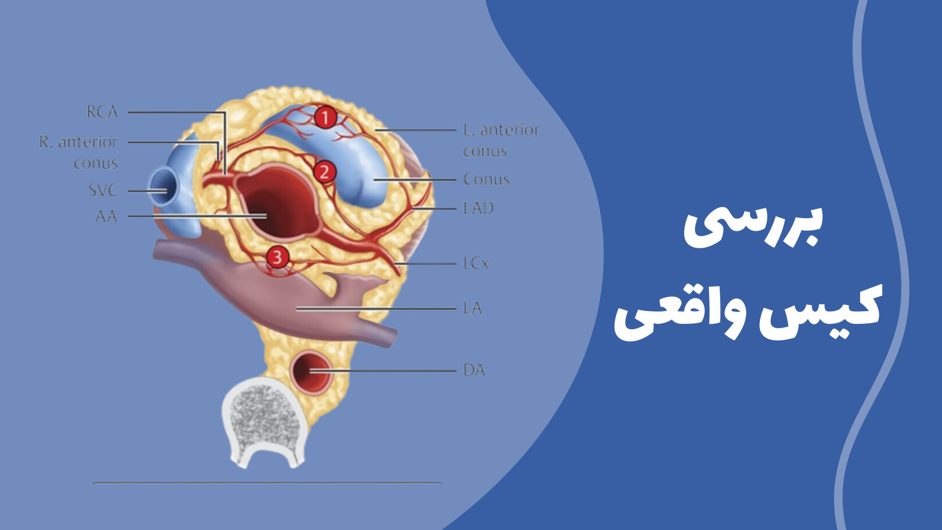 کیس واقعی: آنژین ناشی از استرس و شریان کرونری چپ اکتوپیک گربه فضایی