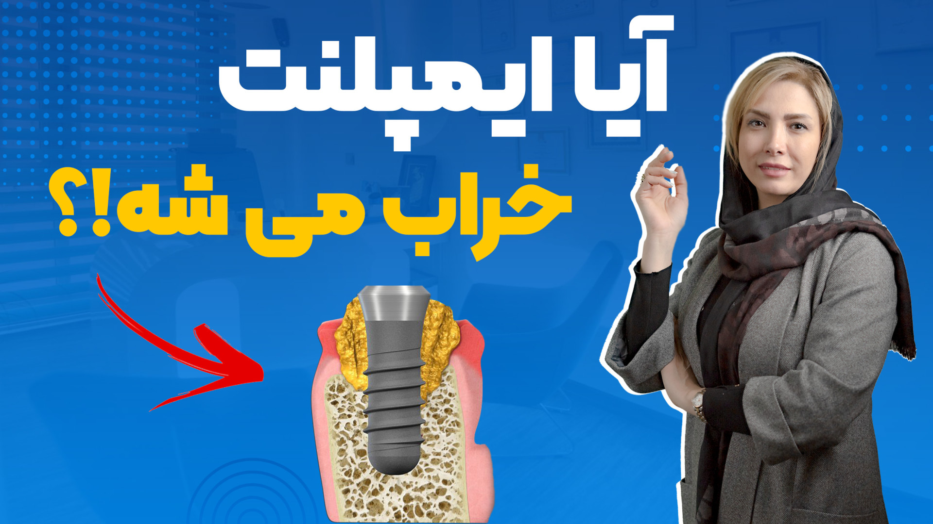 آیا ایمپلنت خراب می شه؟ بیماری هموگلوبین S