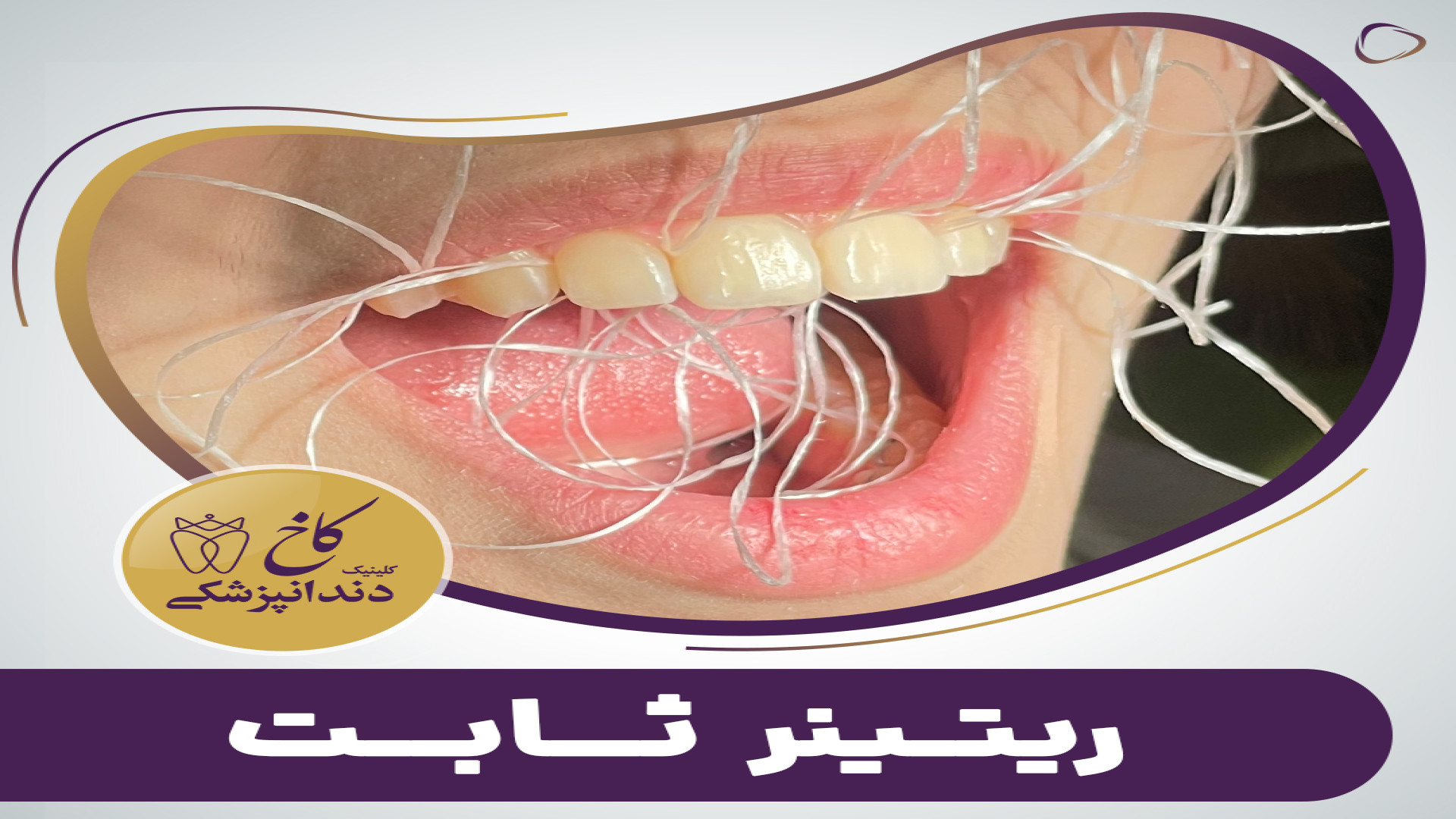 ریتینر ثابت یا سیم پشت دندان کلینیک دندانپزشکی کاخ
