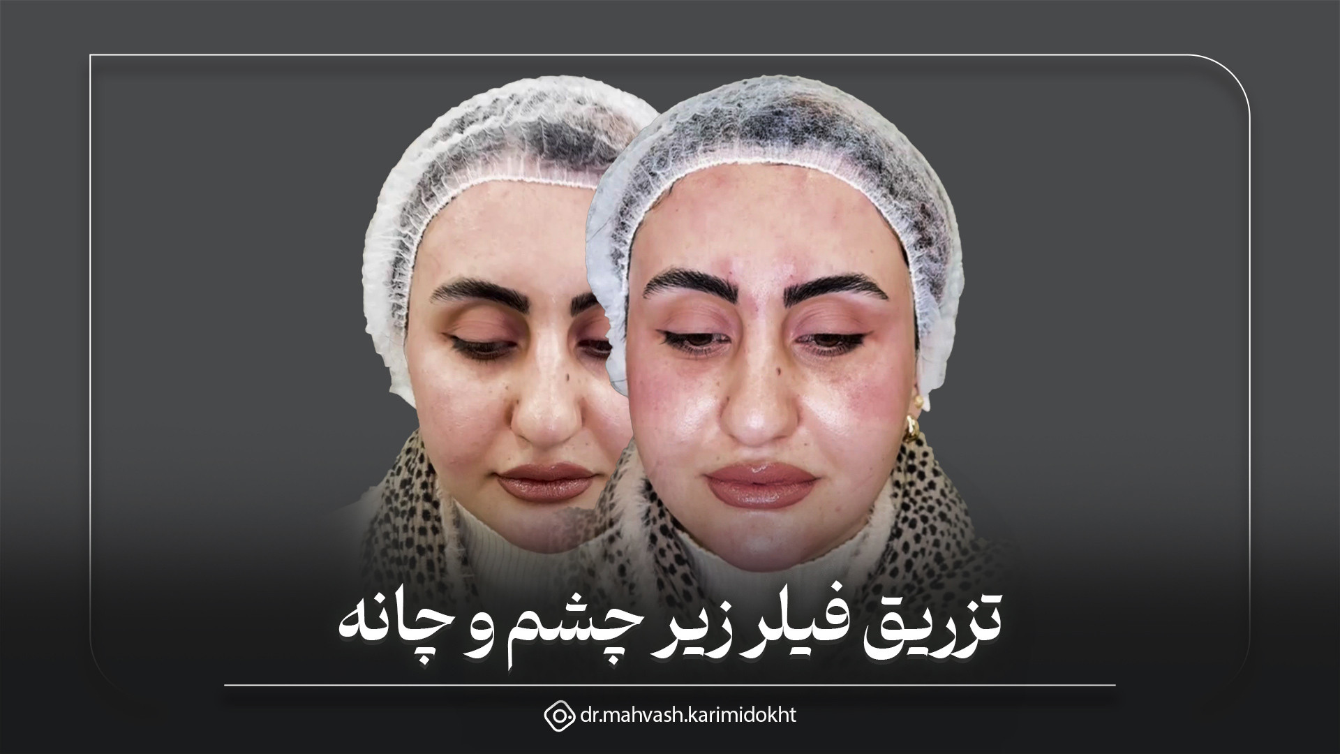 تزریق فیلر زیر چشم و چانه | دکتر مهوش کریمی دخت CUT&Tag