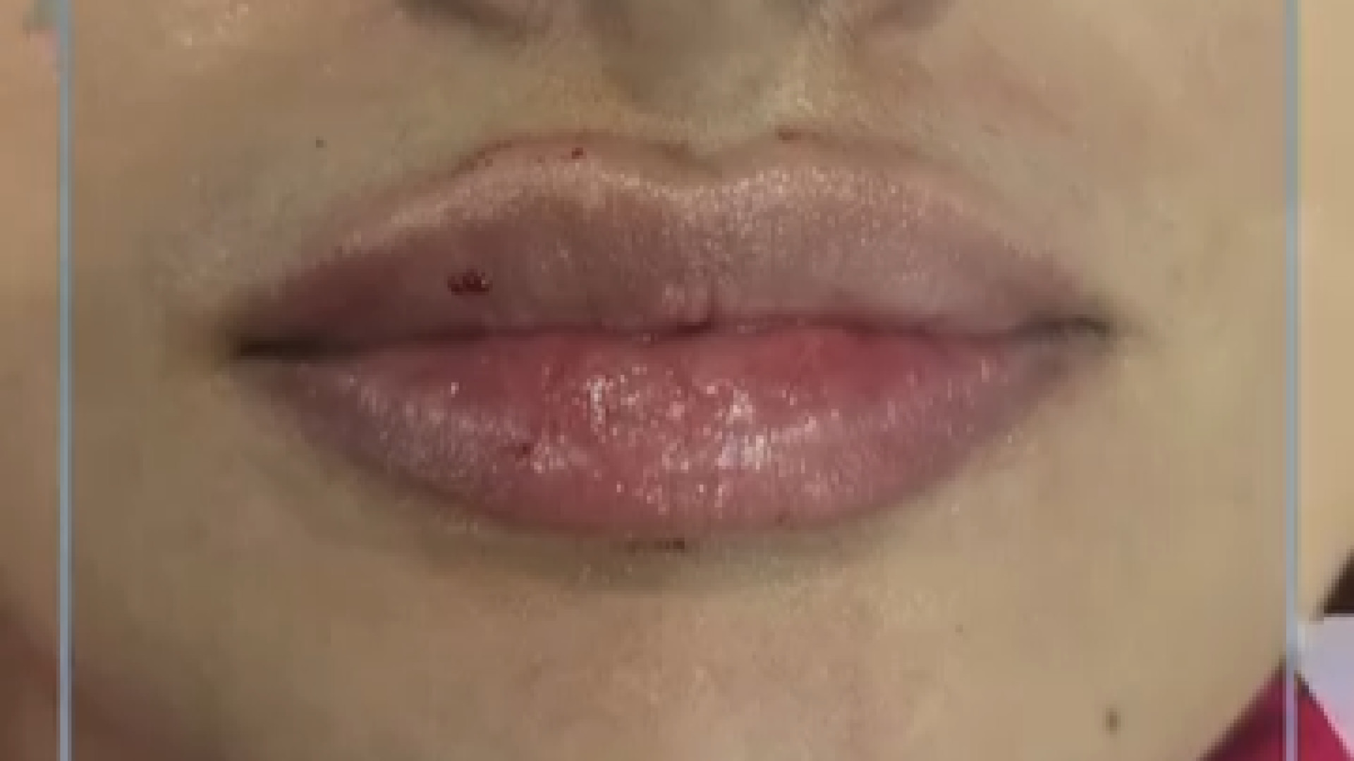 نتیجه تزریق فیلرلب دکتر پروین طاوسی - متخصص پوست، مو و زیبایی