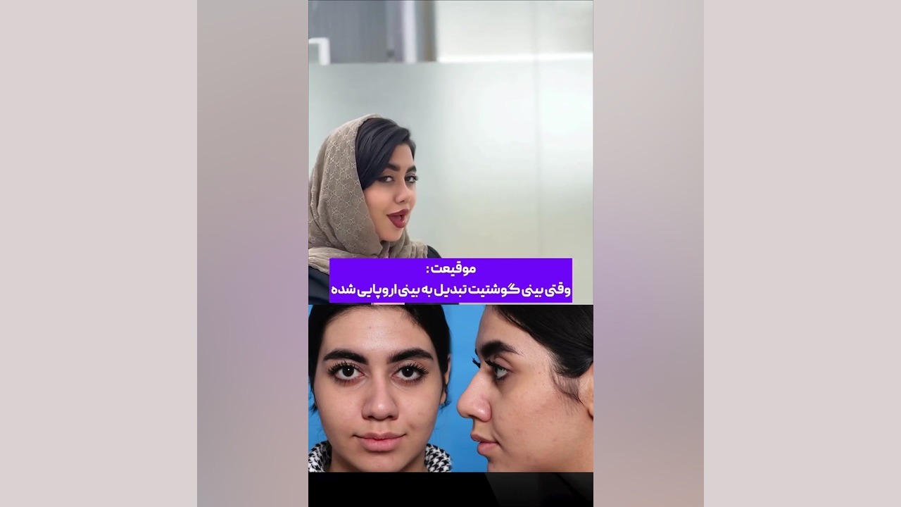 تبدیل بینی گوشتی به بینی اروپایی!! دکتر علی شفیعی رونیزی | بهترین جراح بینی تهران