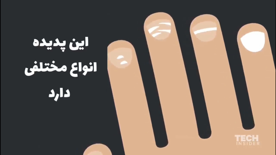 لکه‌های سفید روی ناخن چیست؟