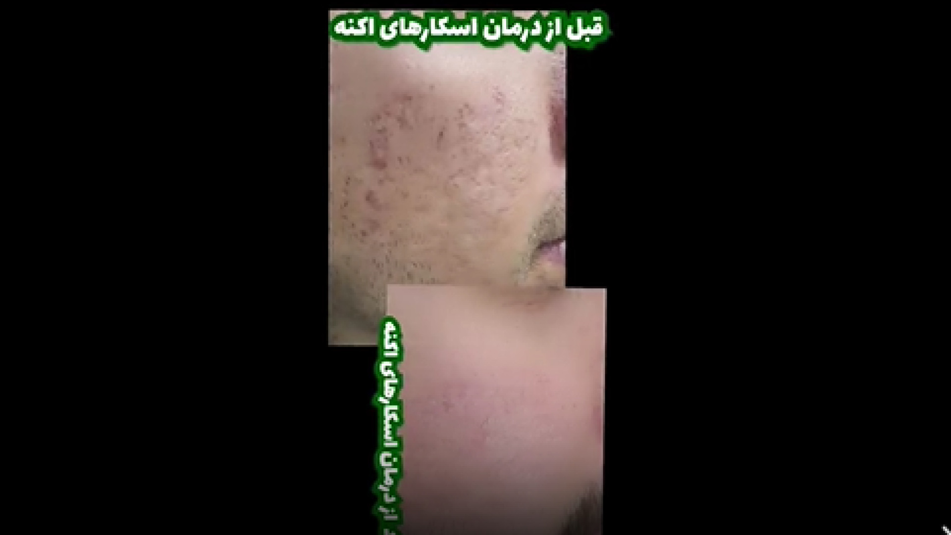 درمان با سابسیژن و لیزر ترکیبی دکتر ایمان روغنی جراح و متخصص پوست و مو