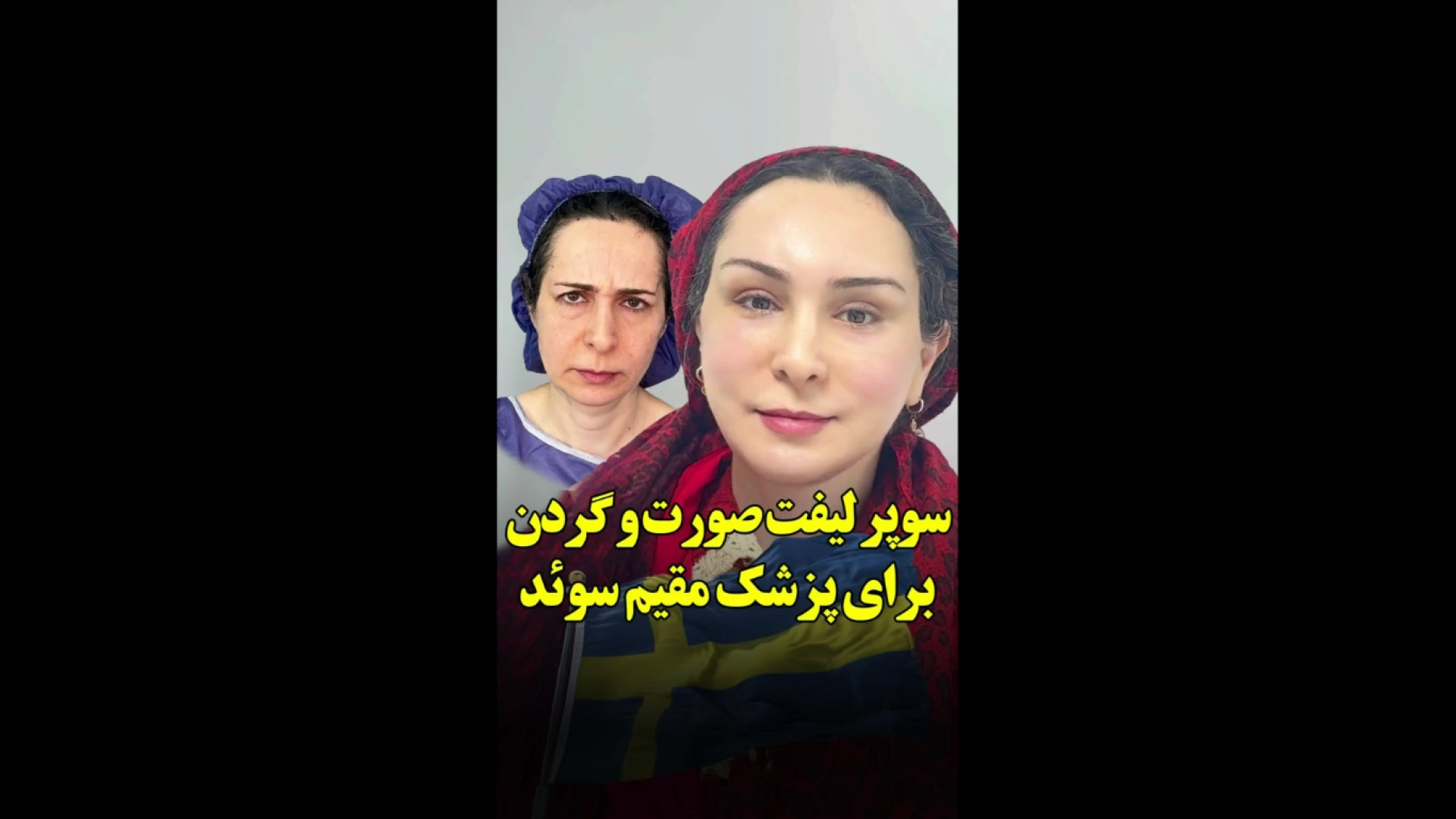 سوپر لیفت صورت و گردن برای پزشک مقیم سوئد انیدروز