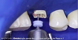 استفاده از پست فایبر با سمان ر...