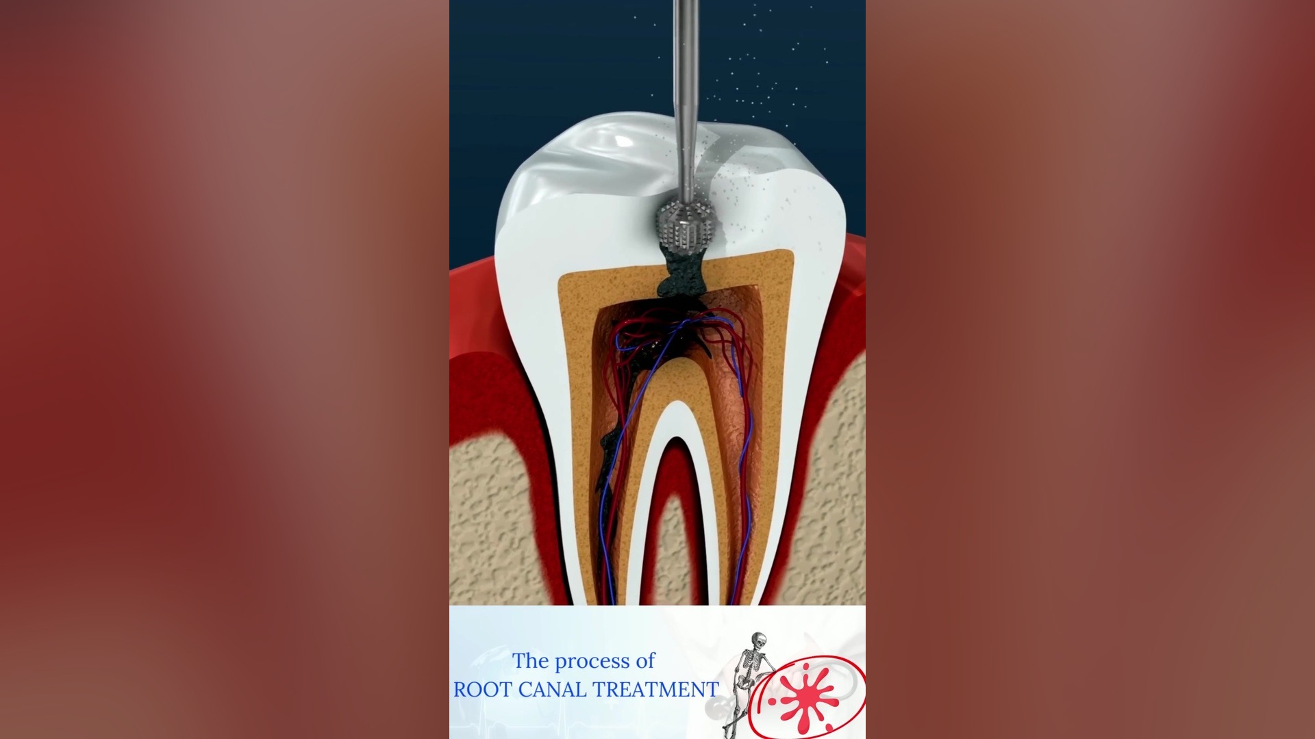 پرکردان دندان و عصب کشی جعفر خوشخواب