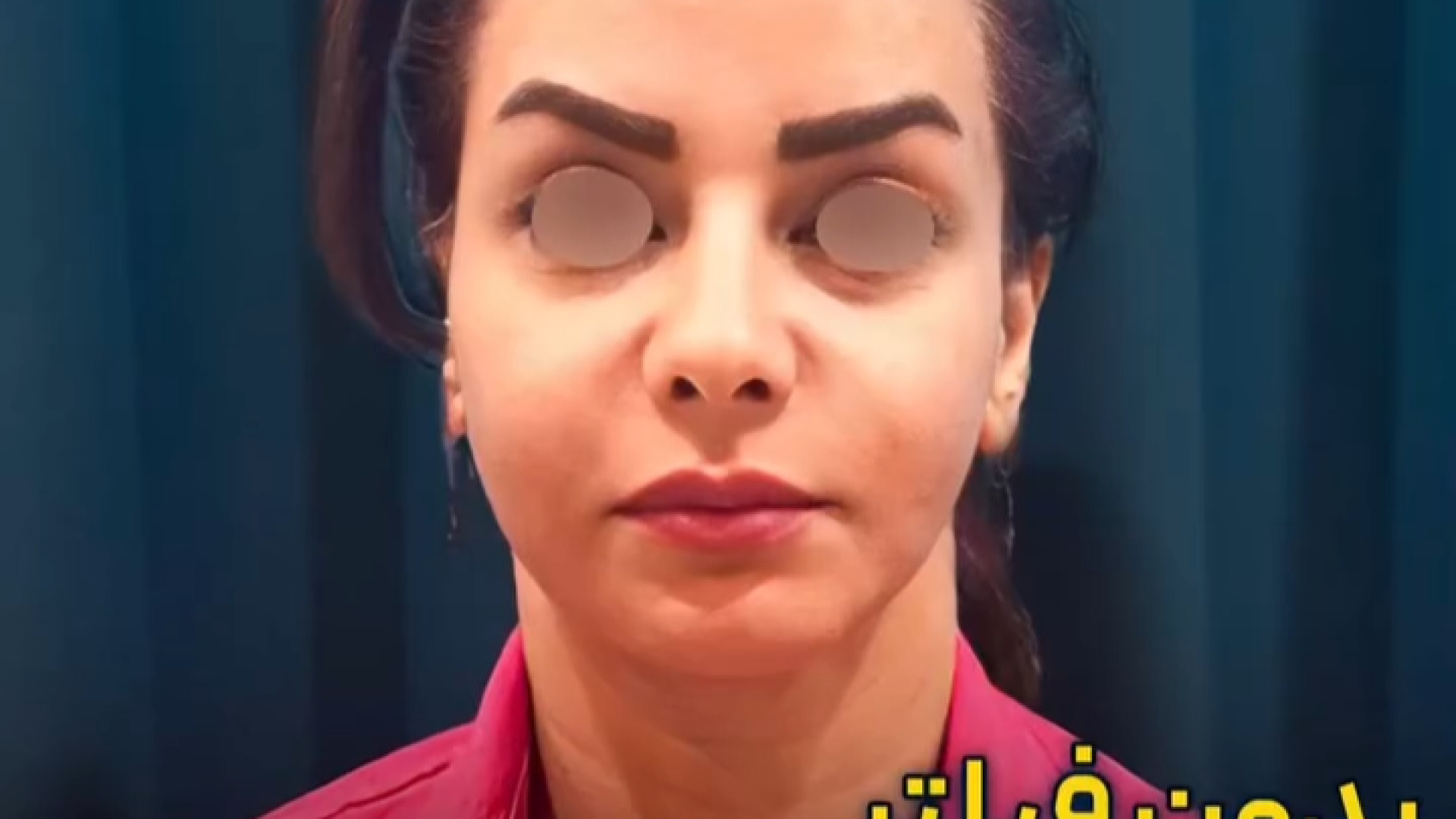 تزریق چربی و لیفت گردن | دکتر عطاالله حیدری رزولین