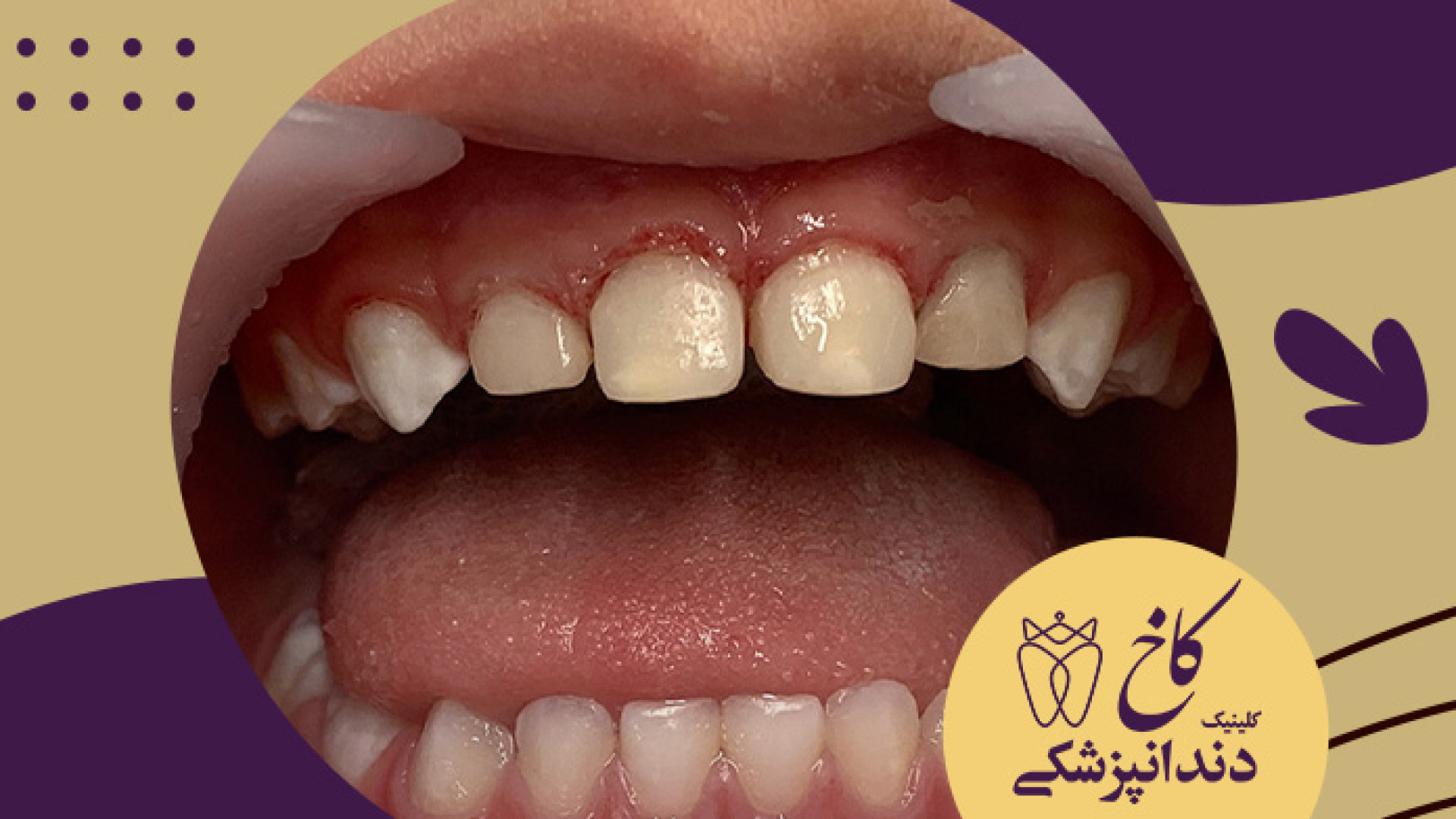 ترمیم دندان شیری تحت بیهوشی کلینیک دندانپزشکی کاخ