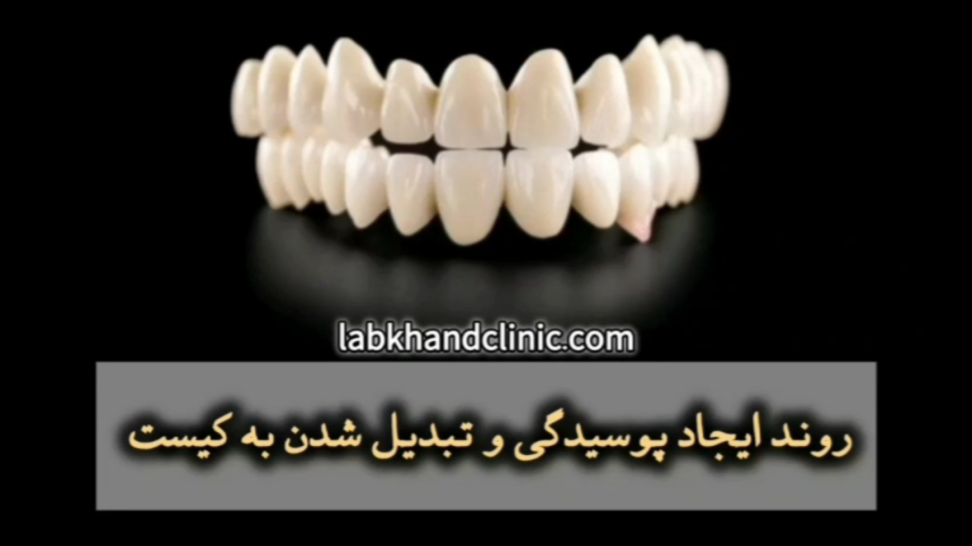 پوسیدگی دندان و تبدیل شدن به کیست، لیزر کوانتومی جراحی چشم