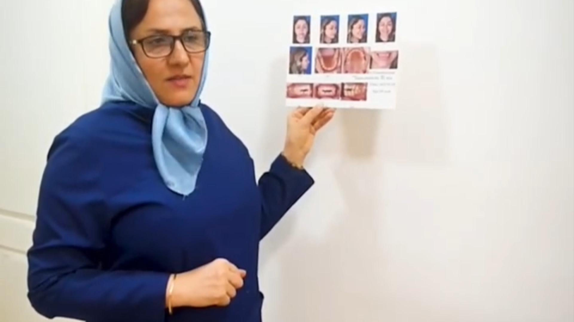 درمان اپن بایت با ارتودنسی دکتر ثریا یوسف نژاد متخصص ارتودنسی بابل