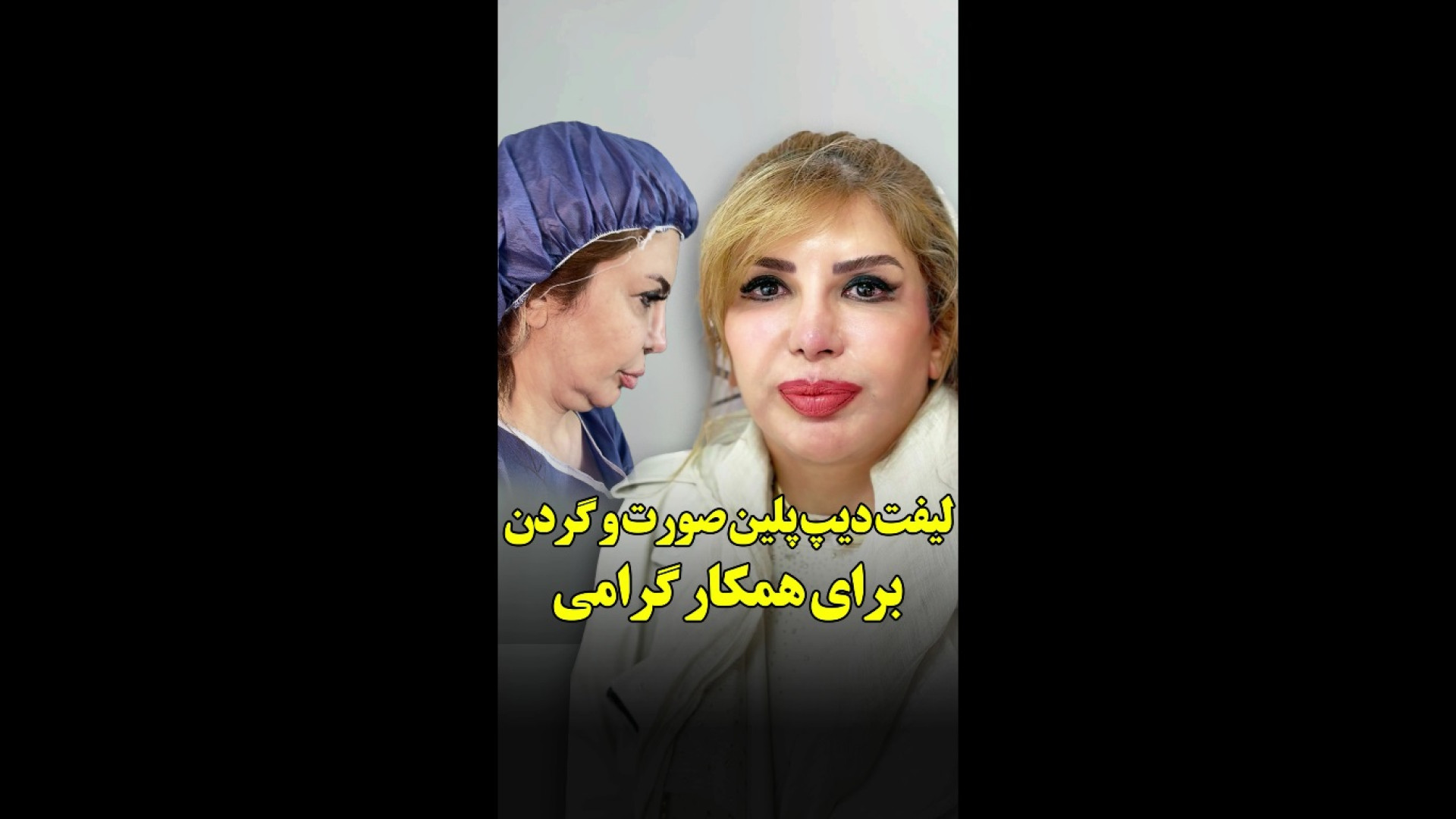 لیفت دیپ پلین صورت و گردن برای همکار گرامی هایپرپاراتیروئیدیسم