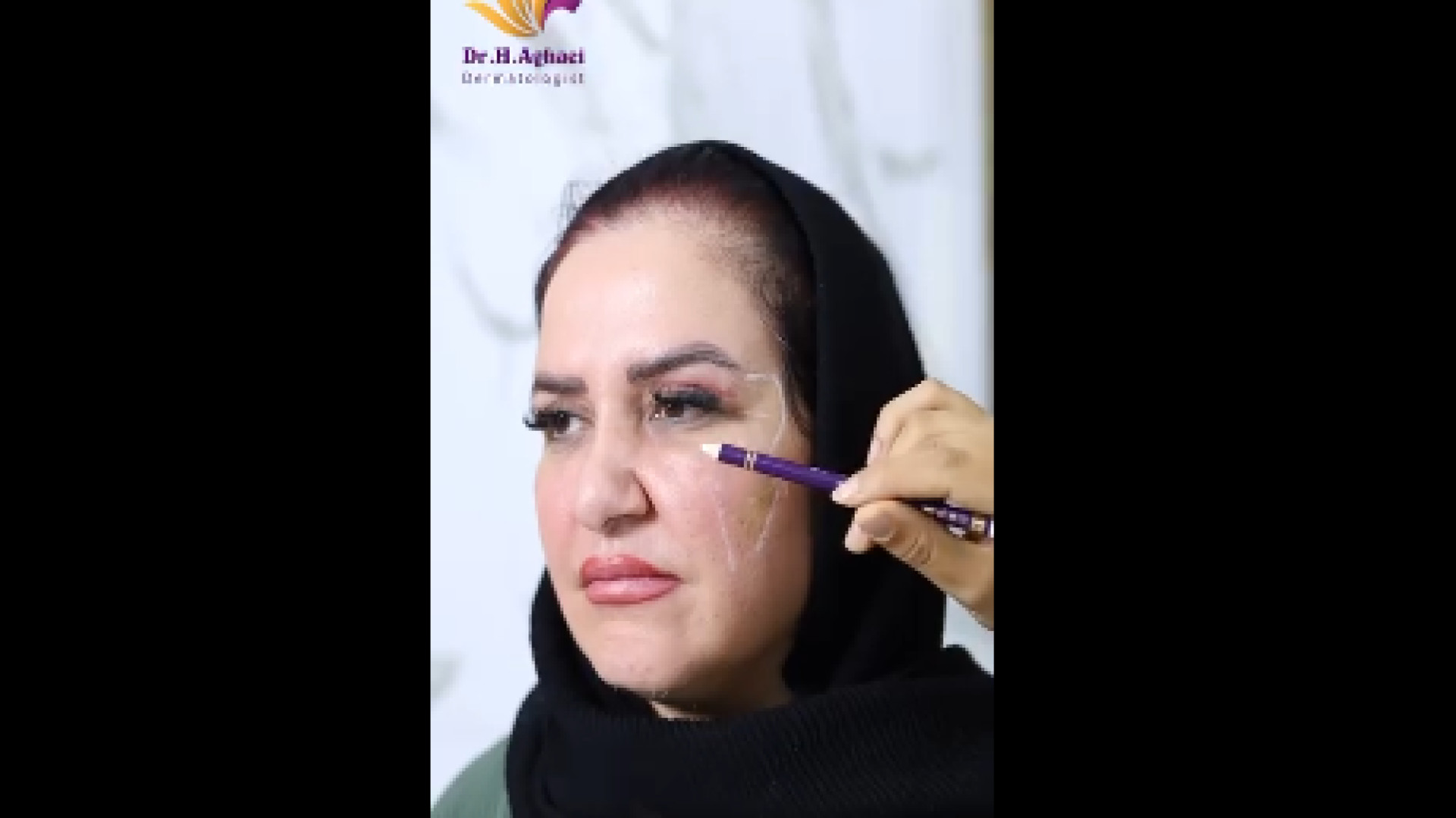 جوانسازی پوست دور چشم دکتر حمیده آقایی