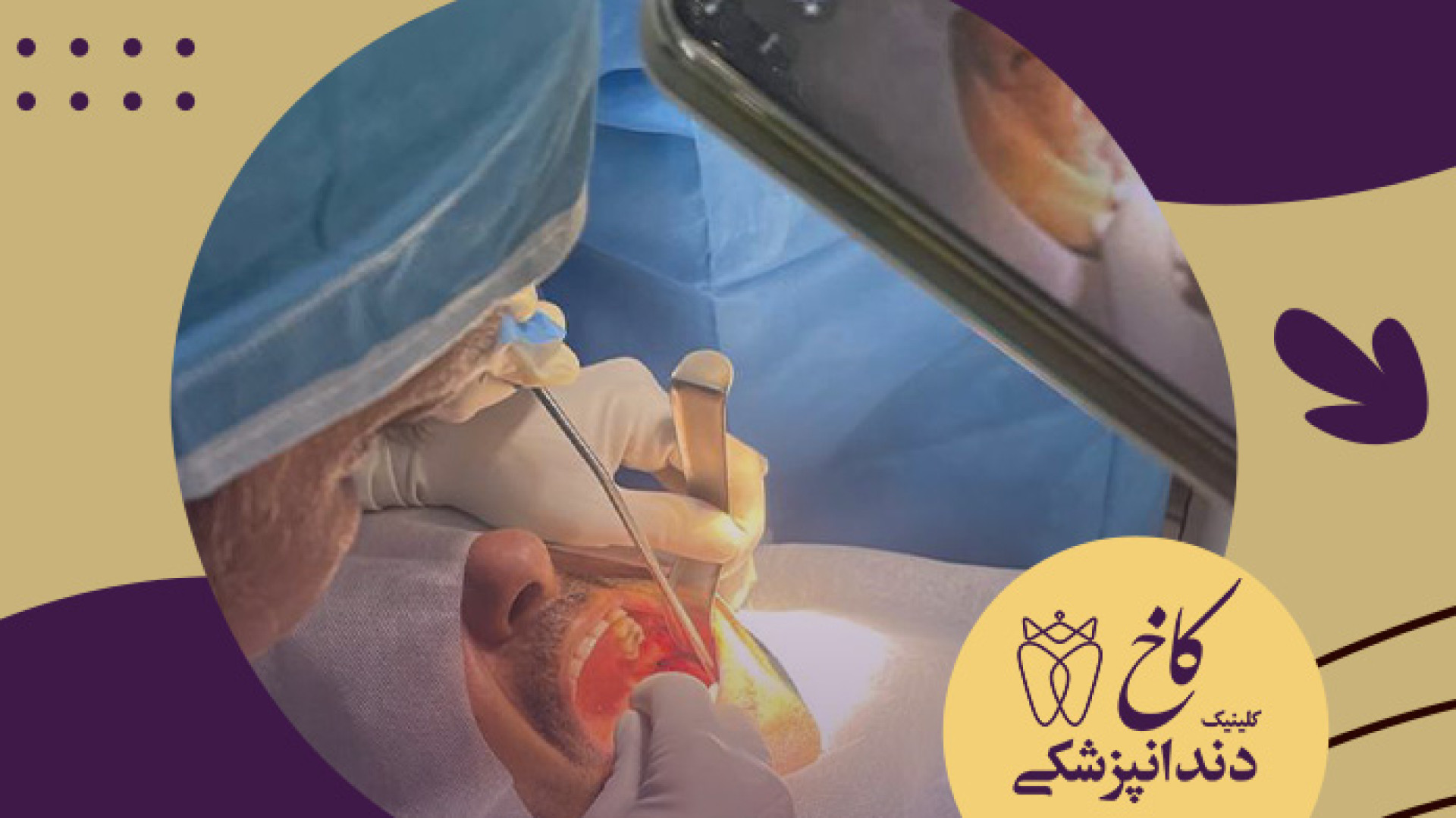 جراحی کیست فک در نبود برق کلینیک دندانپزشکی کاخ