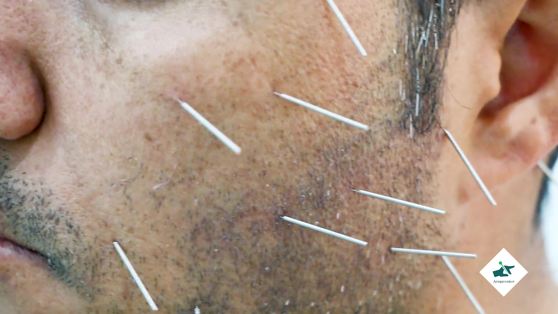طب سوزنی صورت پاکسازی پوست
