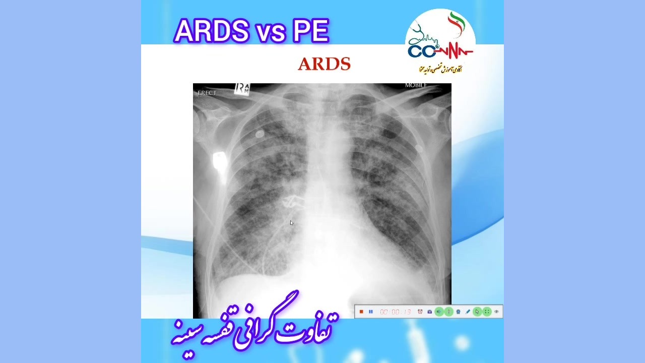 تفاوت ادم ریه و ARDSدر گرافی قفسه سینه منافذ باز پوست