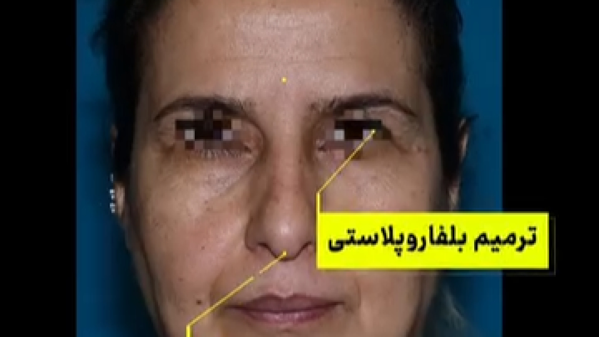 جراحی همزمان رینوپلاستی و لیفت پیشانی دکتر حمید رضا فتحی فوق تخصص جراحی پلاستیک