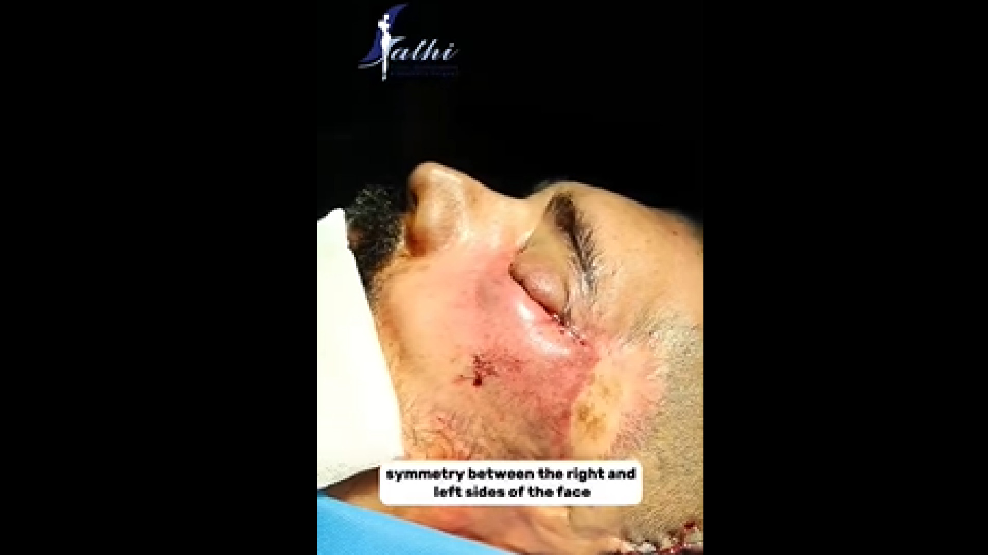 جراحی استخوان جمجمه دکتر حمید رضا فتحی فوق تخصص جراحی پلاستیک