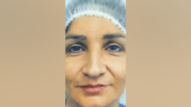 رفع نواقص بینی با جراحی دکتر هاتف زیرک زاده - فوق تخصص جراحی پلاستیک