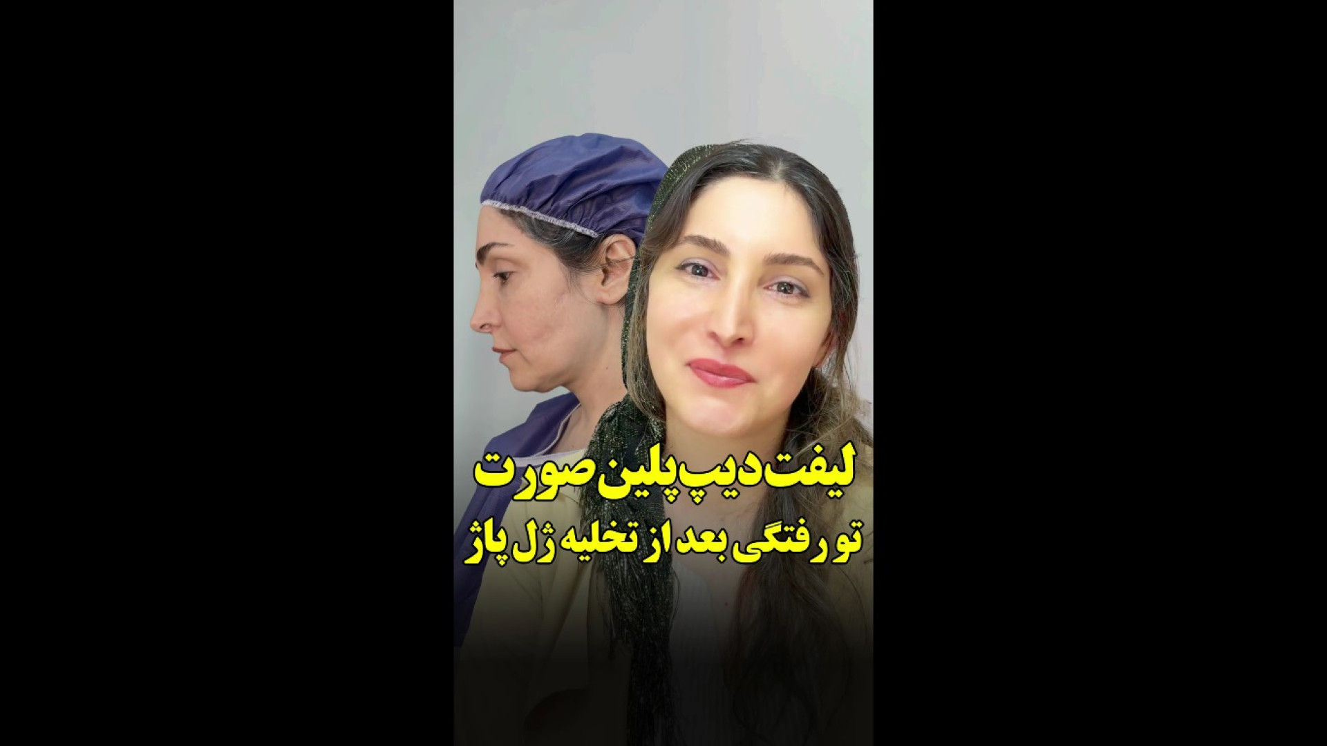 رفع تو رفتگی ناشی از تخلیه ژل پاژ به همراه لیفت دیپ پلین صورت و گردن اندودنتیکس