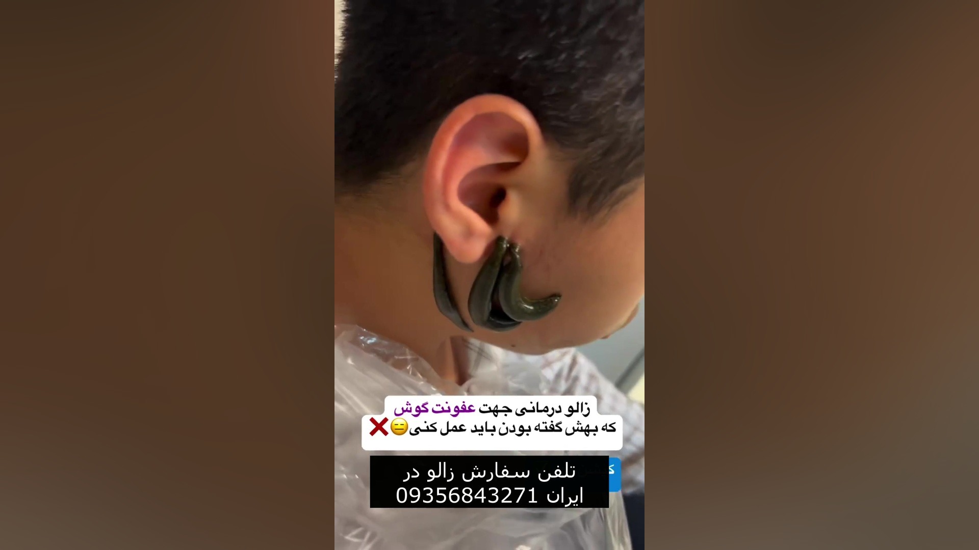 زالودرمانی عفونت گوش و گزگز و التهاب دست و پا بلیچینگ