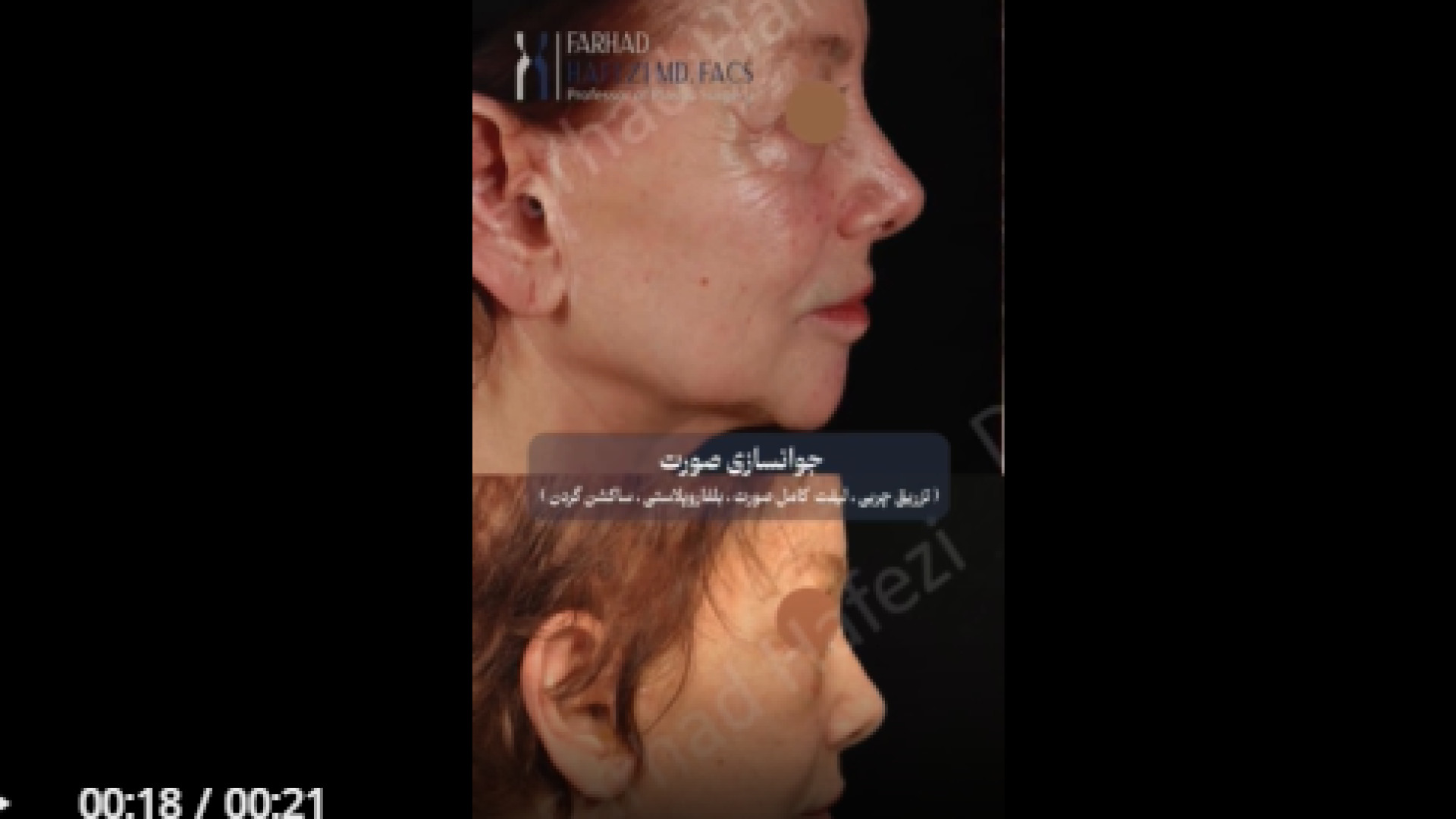 نتیجه جوانسازی صورت دکتر فرهاد حافظی