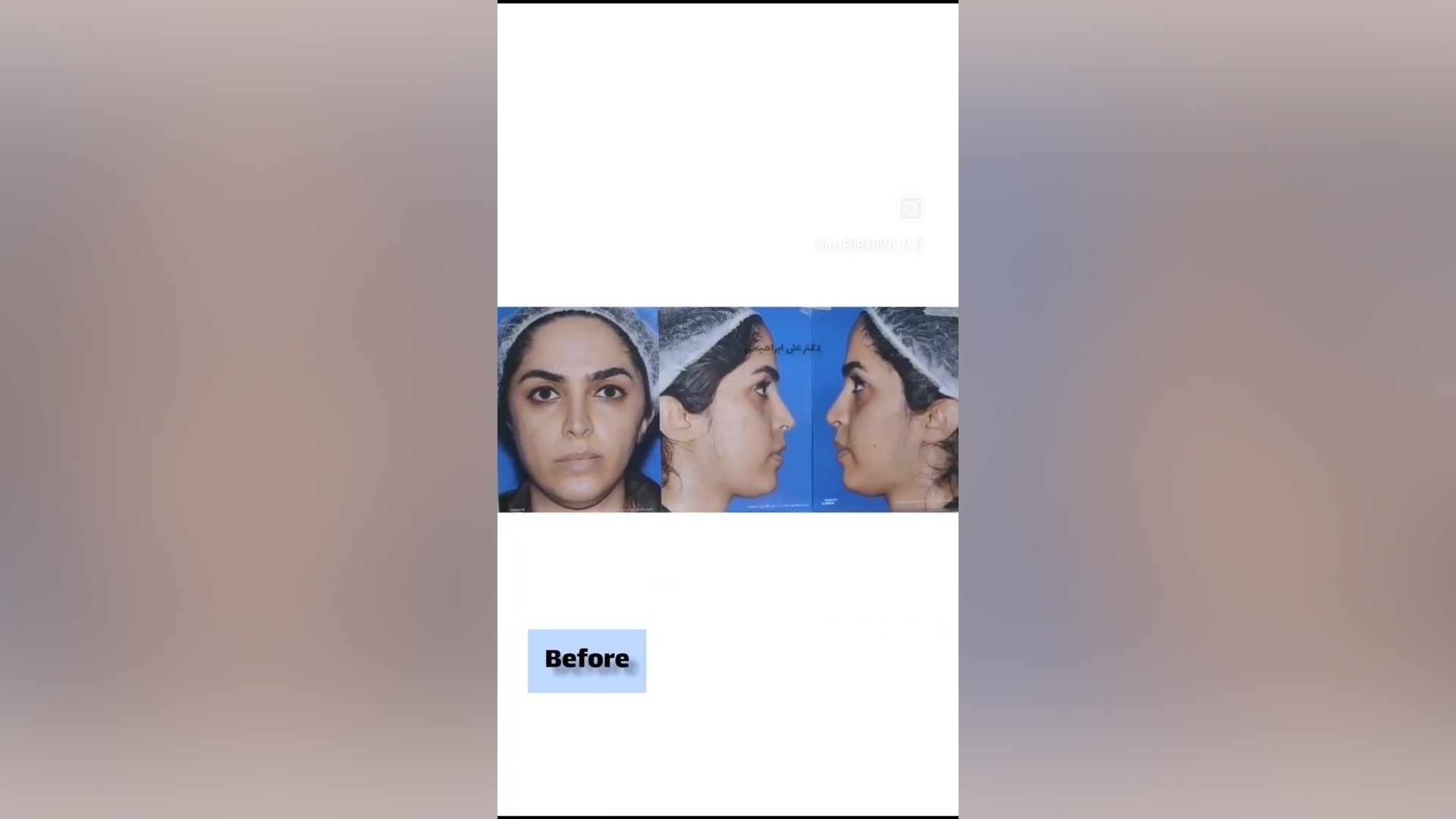 پروتز زاویه فک و تزریق چربی دکتر علی ابراهیمی فوق تخصص جراحی پلاستیک .