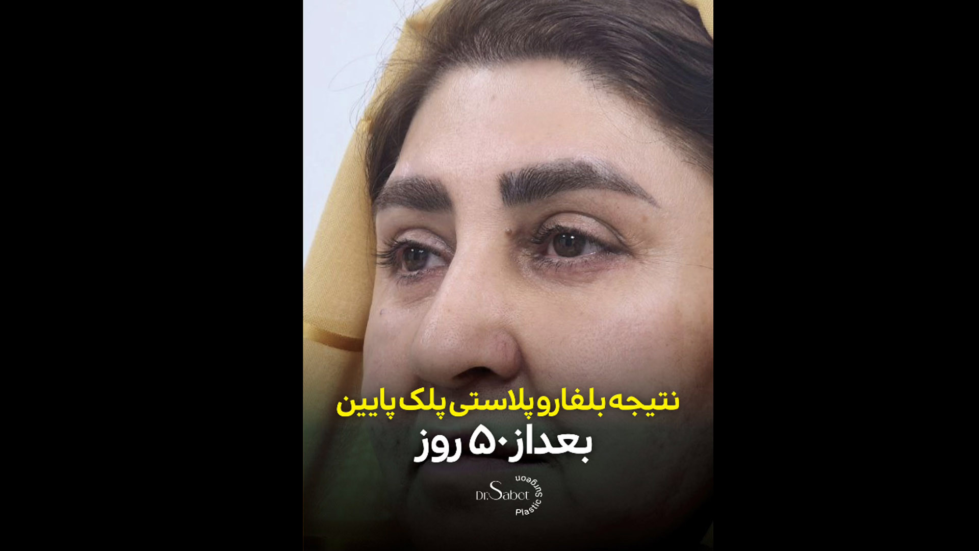نمونه کار عمل بلفاروپلاستی پلک پایین پیلینگ