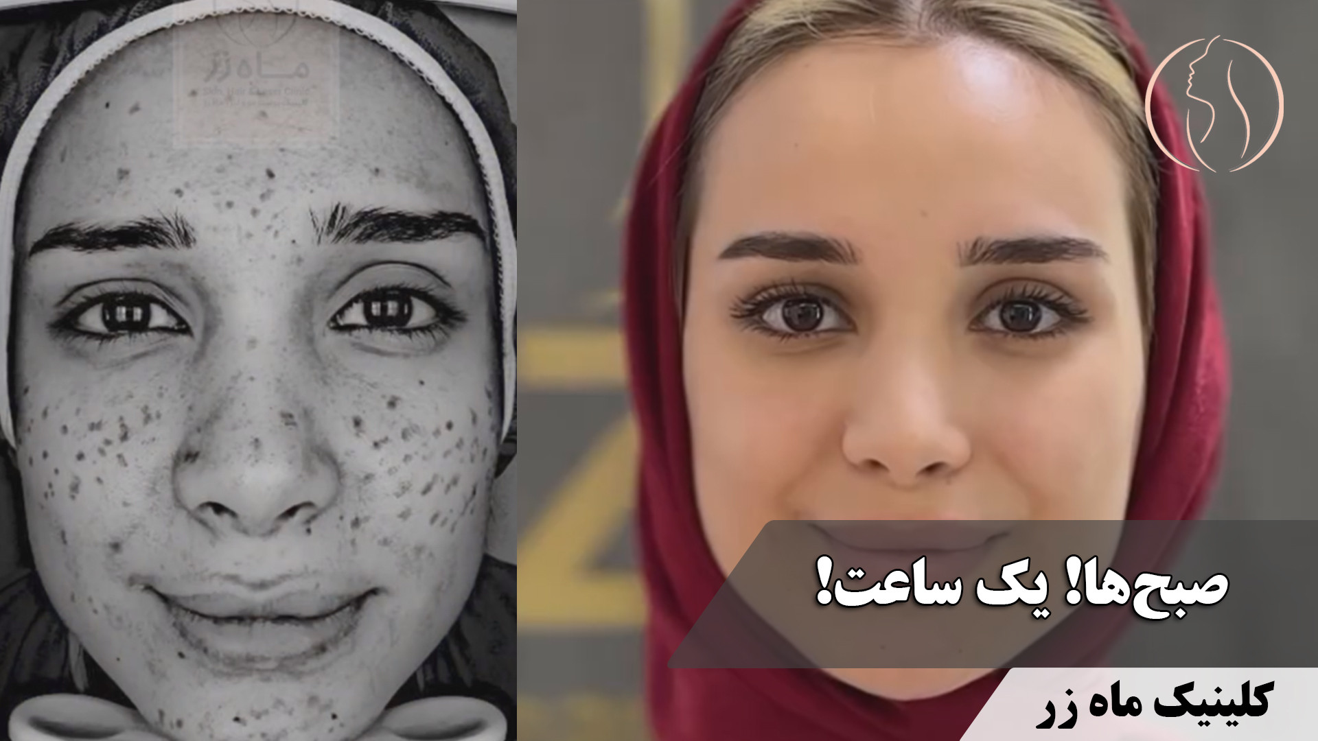 یه ساعت آرایش هر صبح ( کلینیک زیبایی ماه زر ) ترمیم سوختگی