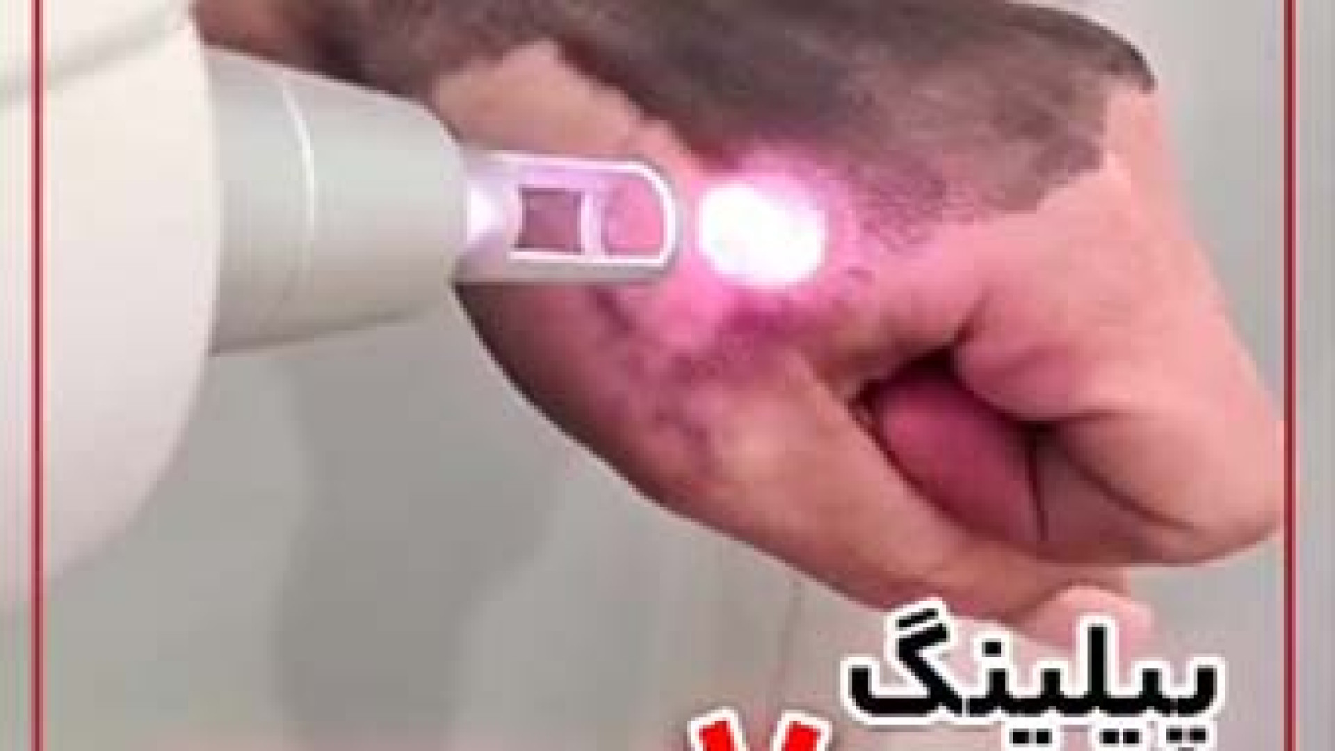 پیلینگ هالیوودی | دکتر مریم بیکی دکتر مریم بیکی - پوست و مو و زیبایی اراک