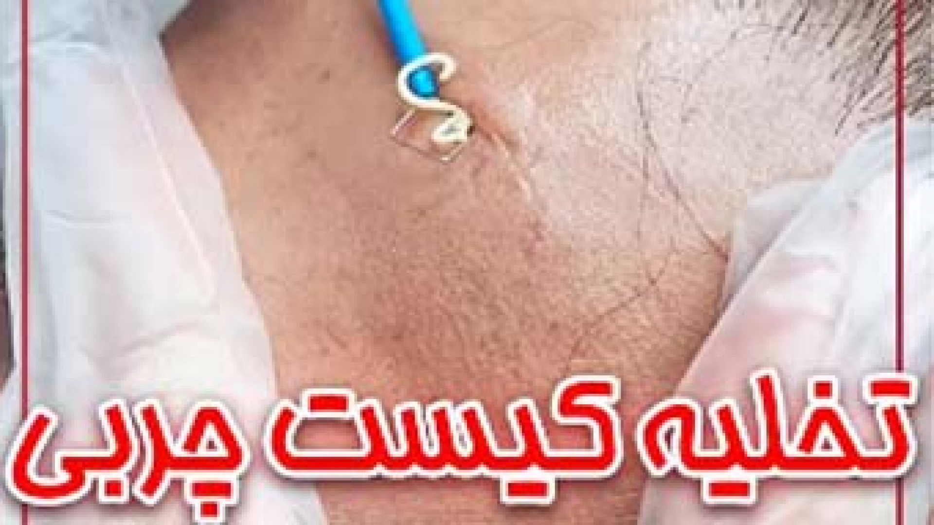 تخلیه کیست چربی | دکتر مریم بیکی دکتر مریم بیکی - پوست و مو و زیبایی اراک