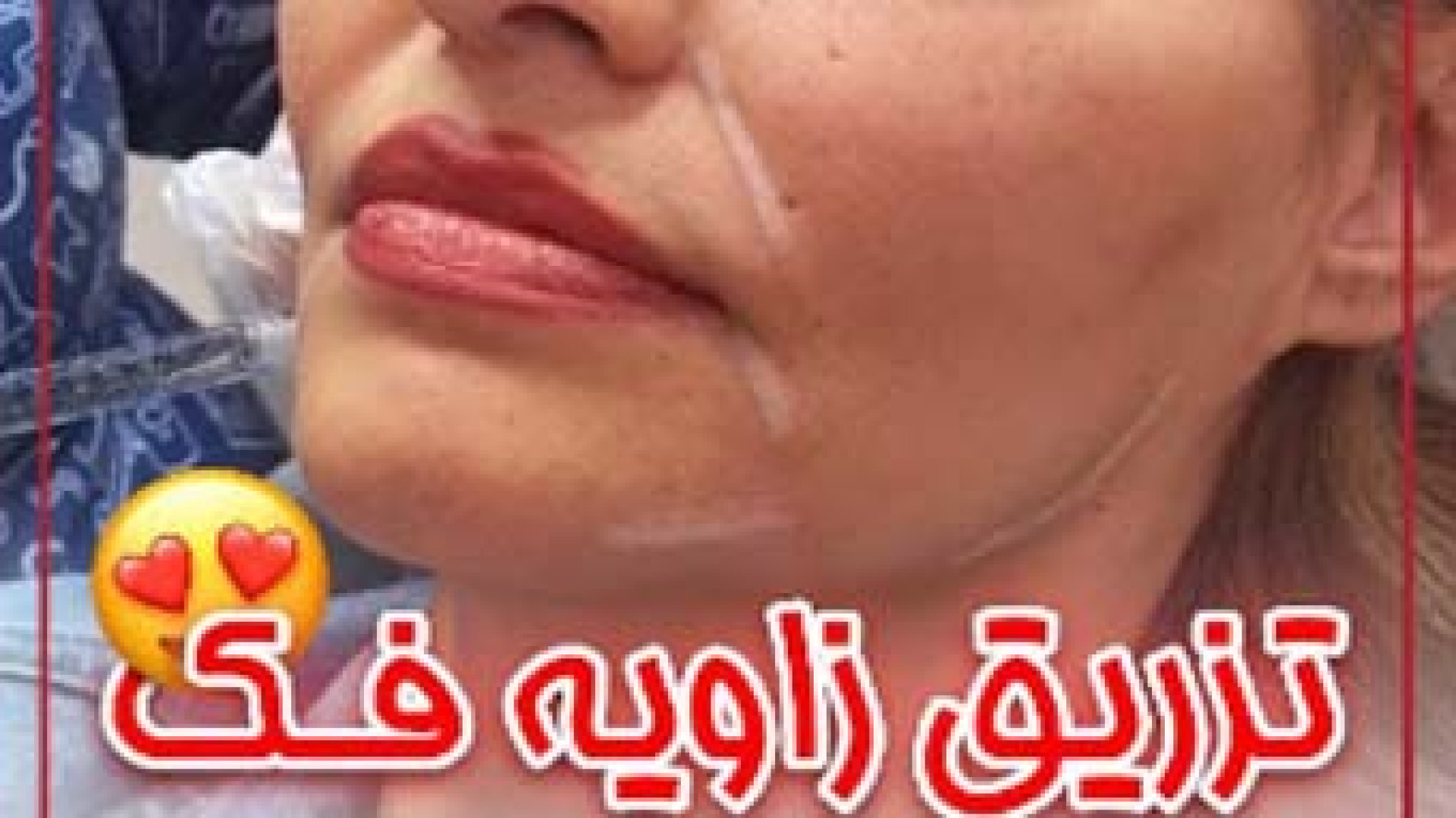 زاویه سازی فک | دکتر مریم بیکی دکتر مریم بیکی - پوست و مو و زیبایی اراک