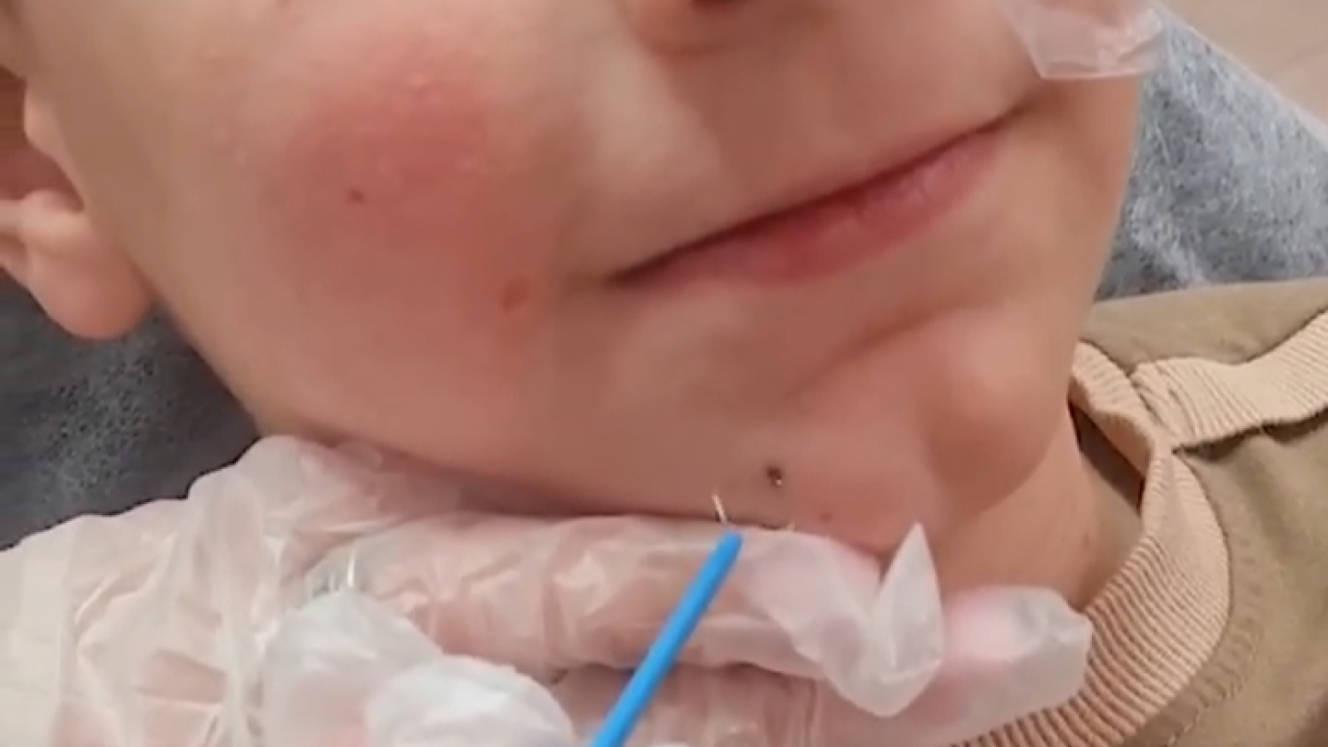 برداشتن خال صورت | دکتر مریم بیکی دکتر مریم بیکی - پوست و مو و زیبایی اراک