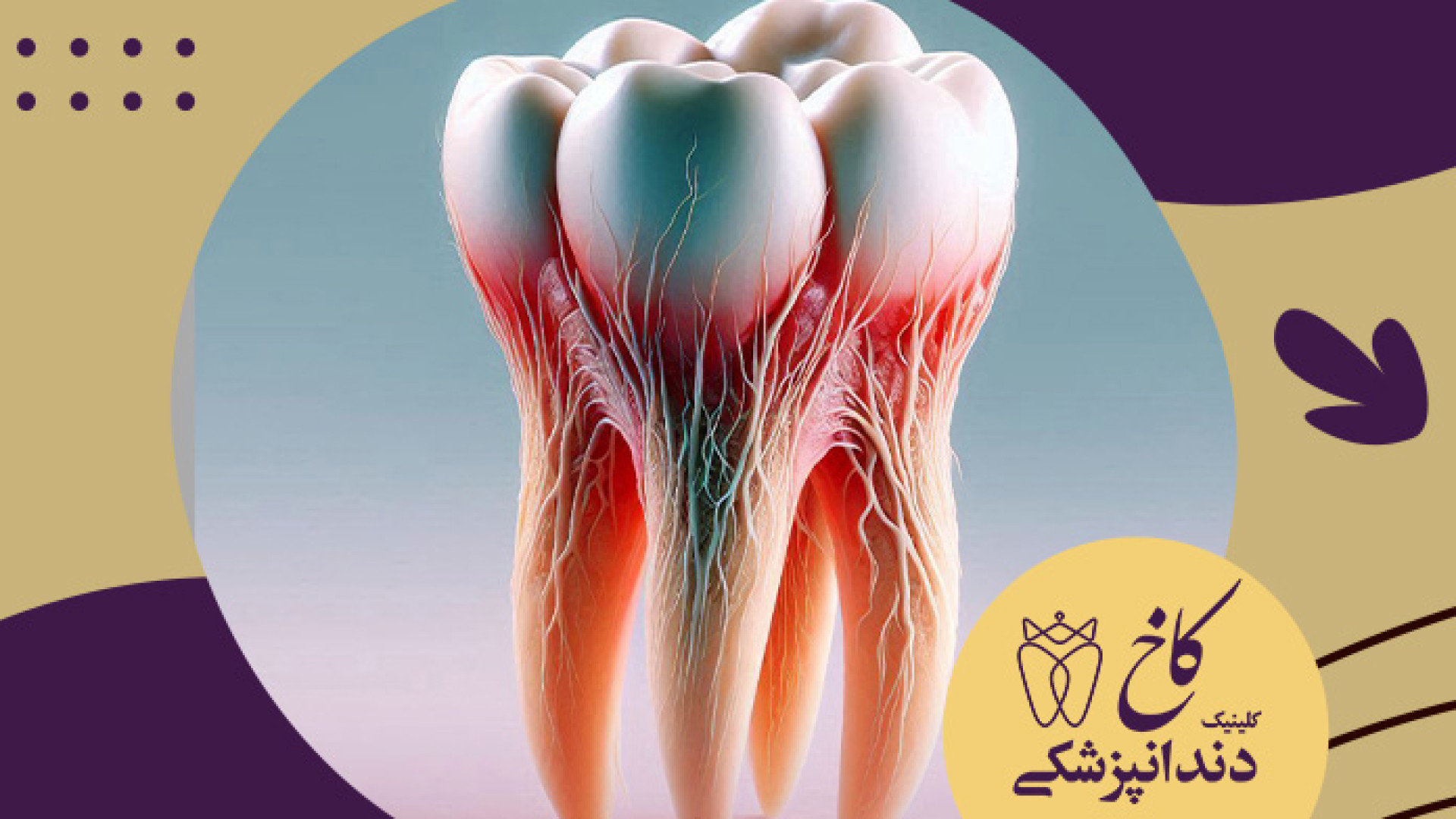 کشیدن دندان به روش ساده یا جراحی؟ کلینیک دندانپزشکی کاخ