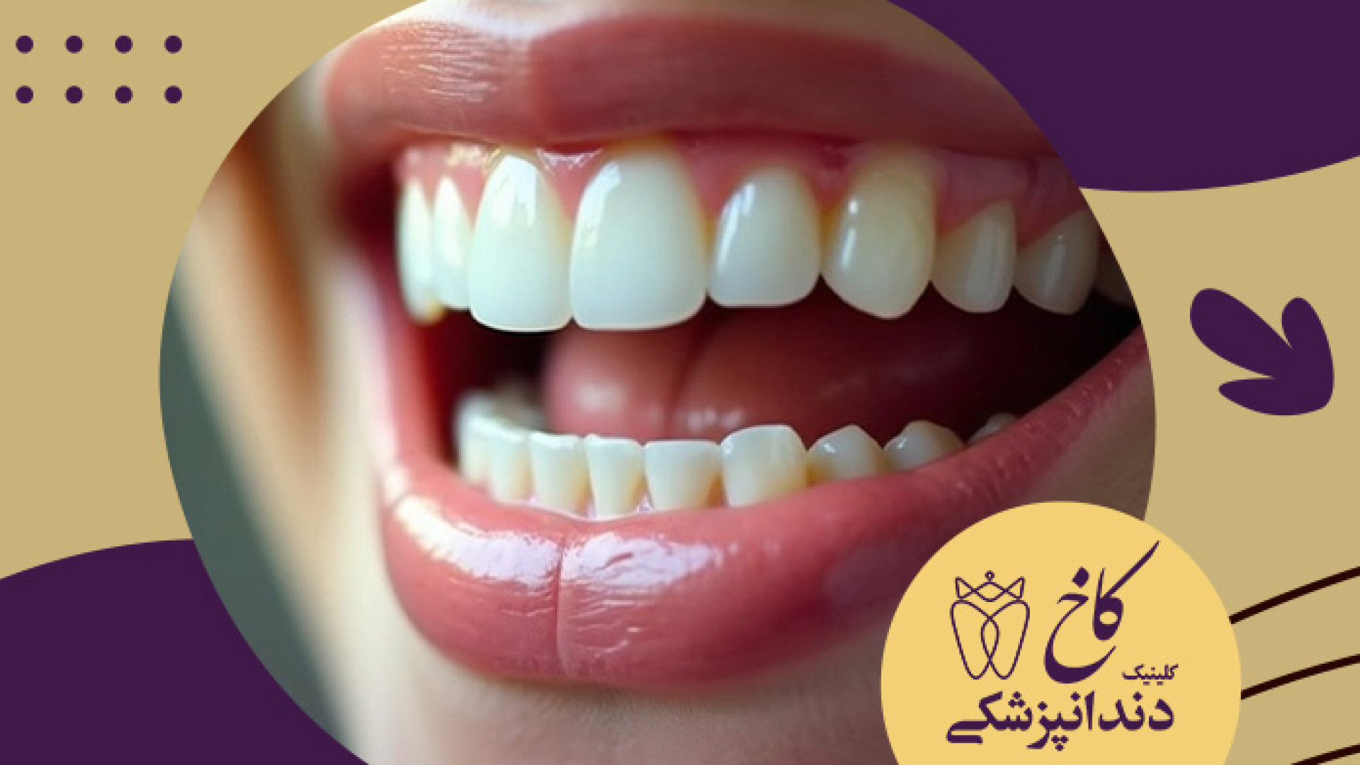 راه حل داشتن دندان سفید کلینیک دندانپزشکی کاخ