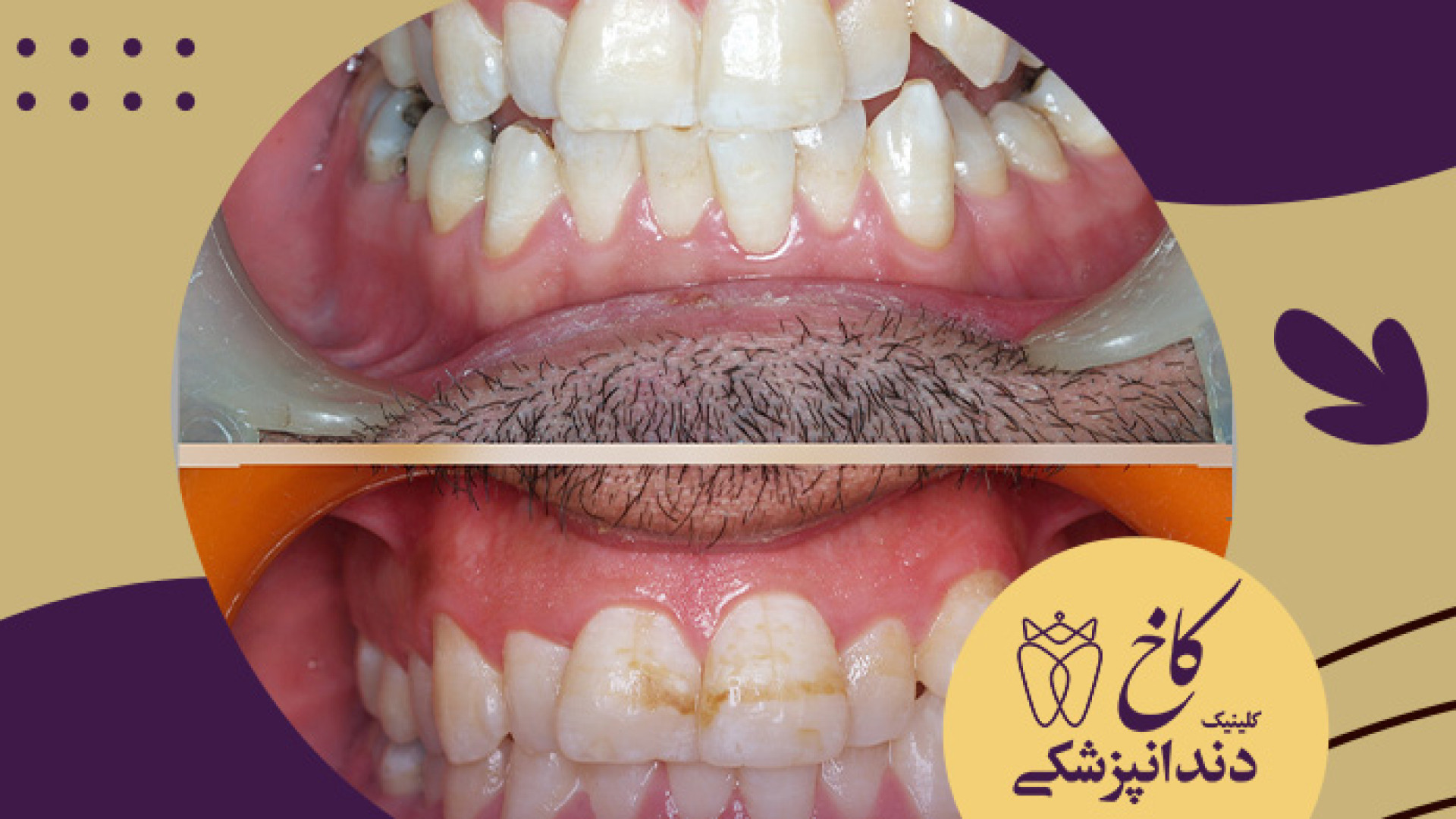 ماندگاری درمان بعد 10 سال کلینیک دندانپزشکی کاخ