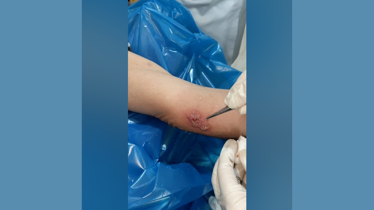 جلسه اول درمان بیماری نادر fixed drug eruption (FDE) توسط پانسمان شگفت انگیز ASO Test